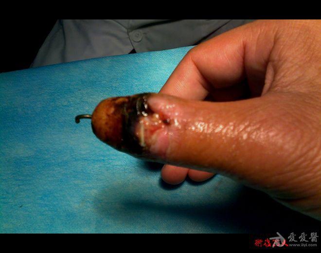 拇指摩托车链条碾压伤