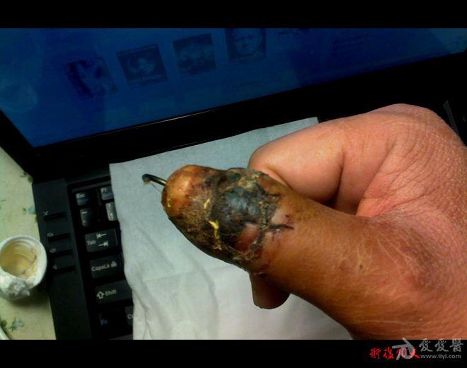 拇指摩托车链条碾压伤