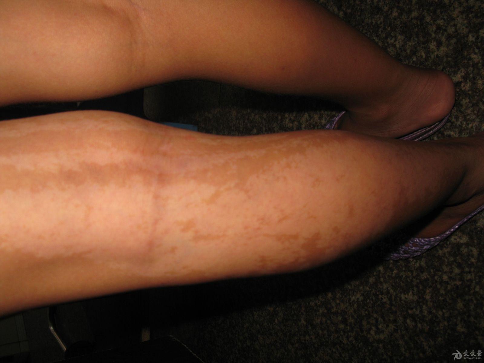 皮肤病你瞧小女孩身体