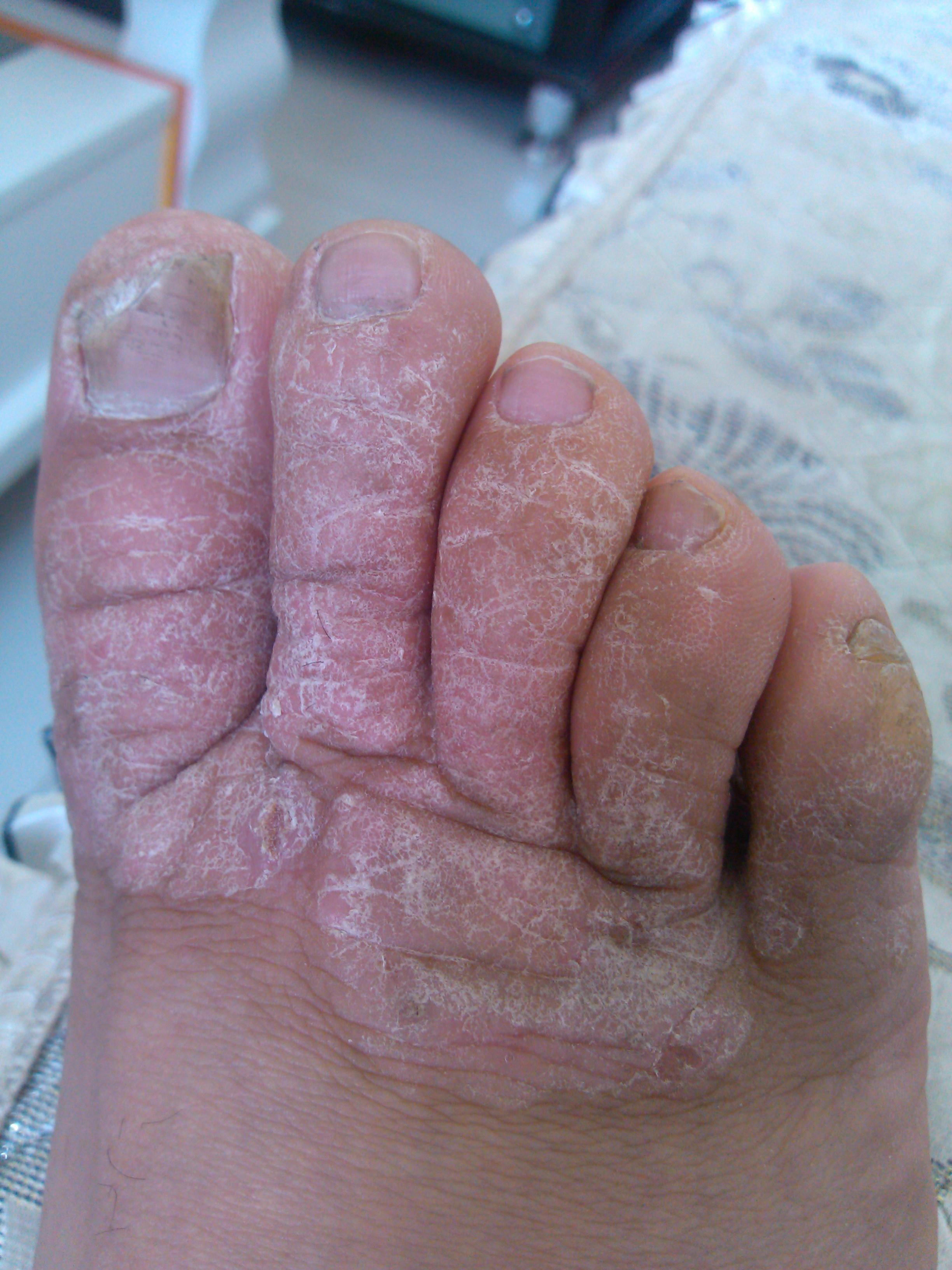 脚上的疾病有哪些图片图片