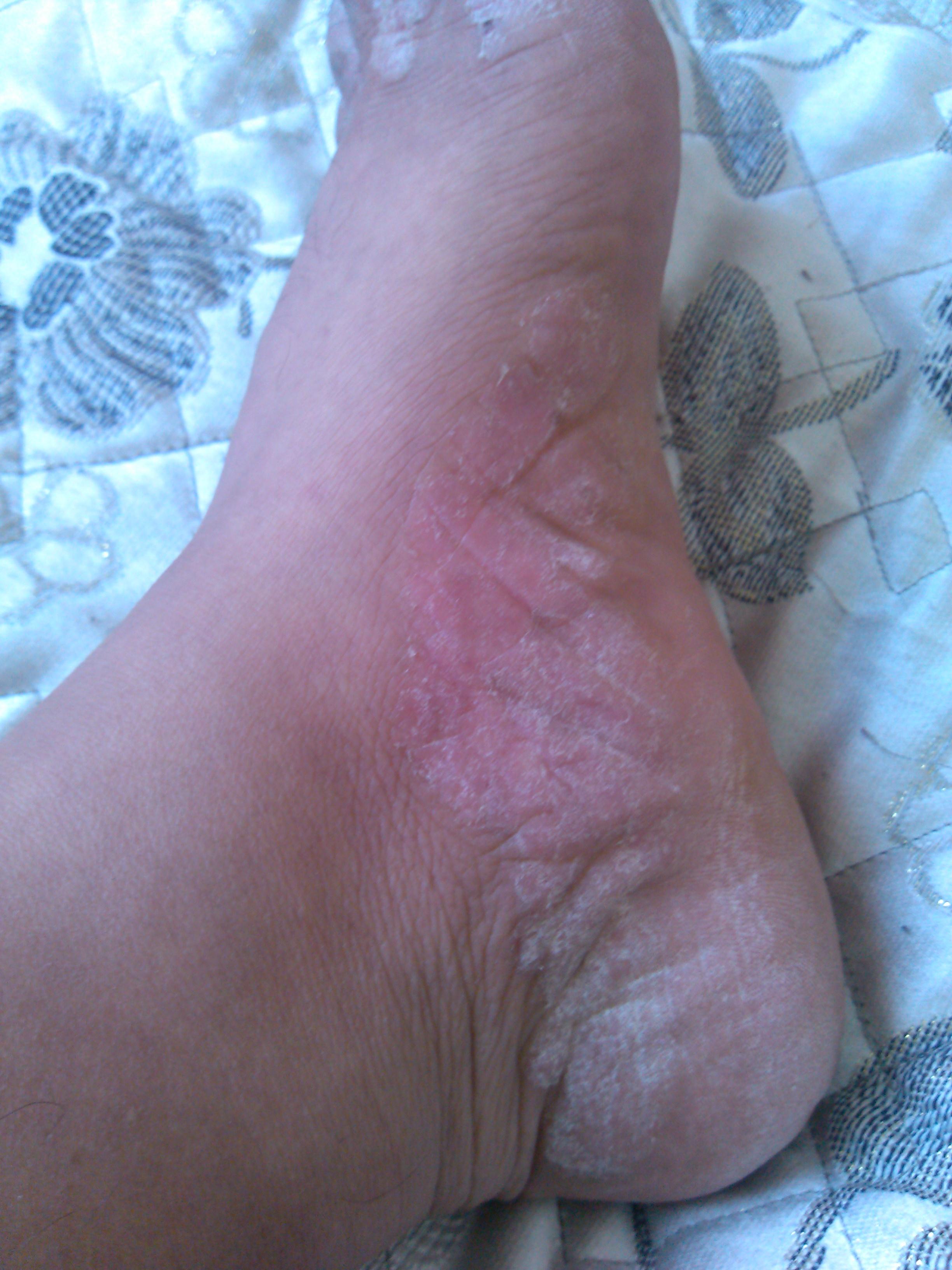 脚脂溢性皮炎初期图图片