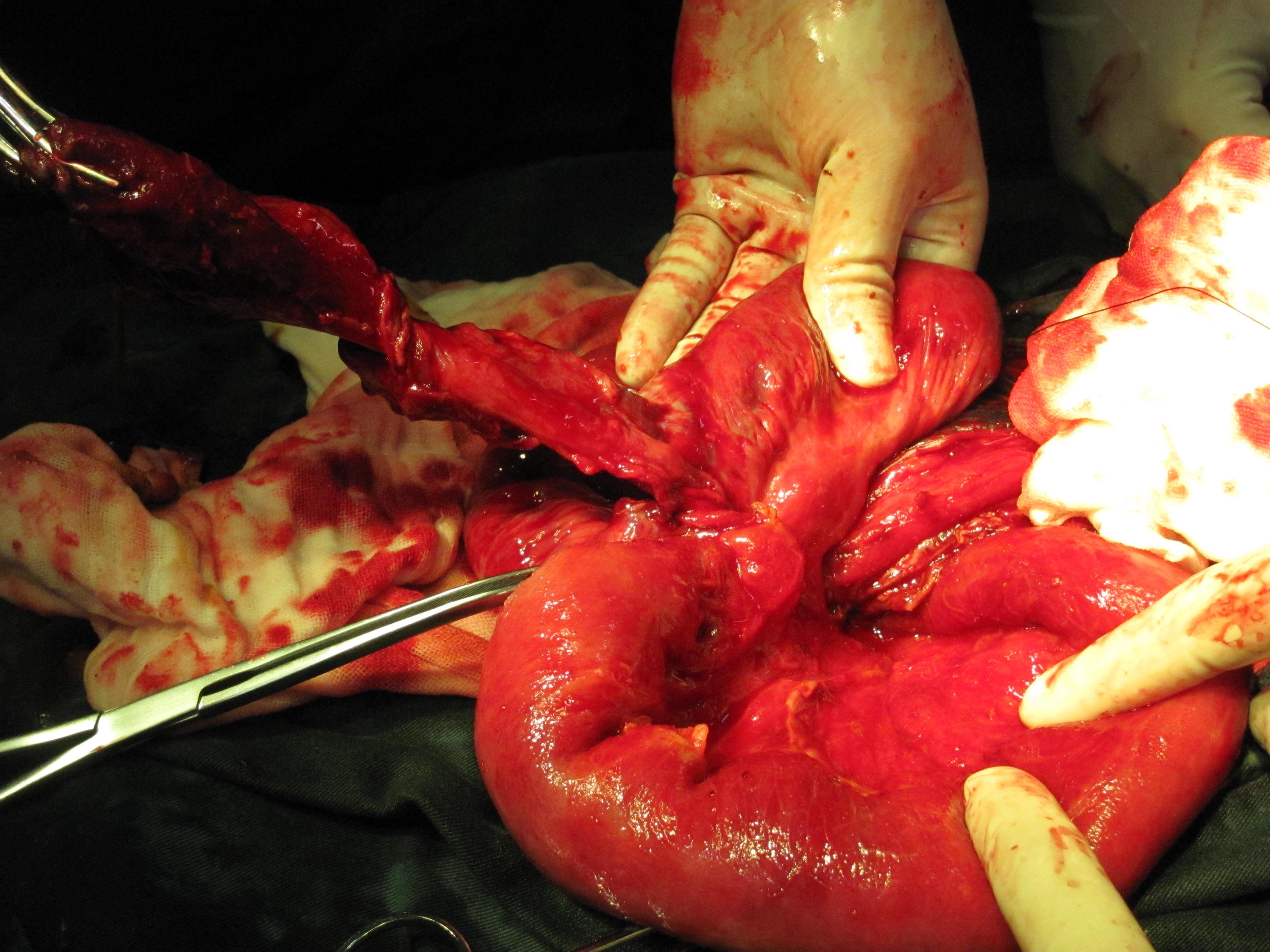 少见这般大美克尔憩室