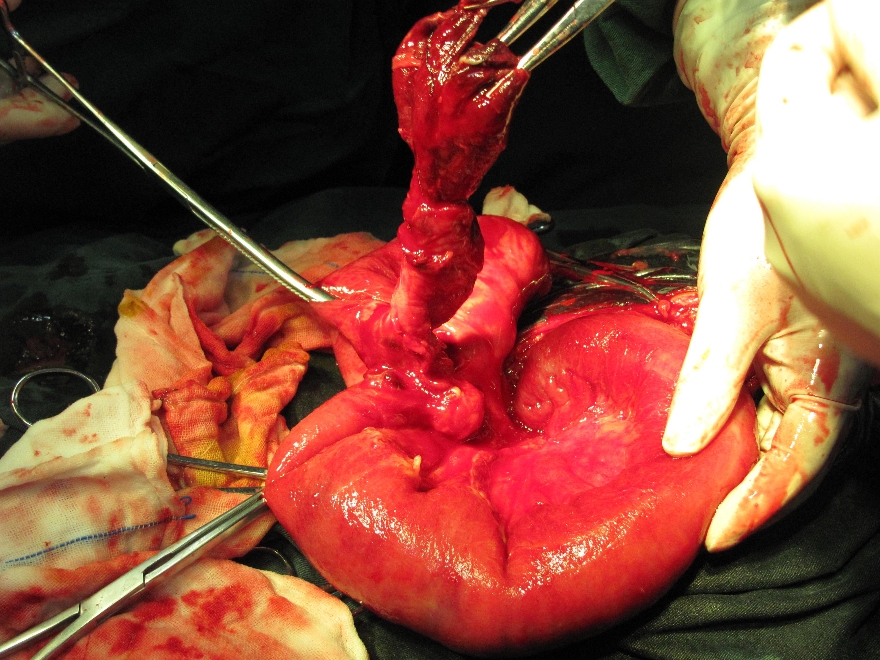 少见这般大美克尔憩室