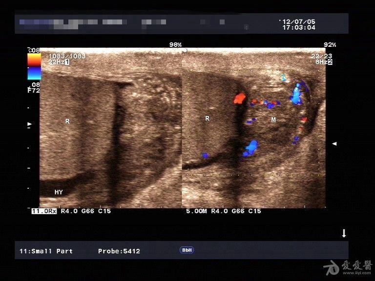 精索附睾炎一例. - 超声医学讨论版 - 爱爱医医学论坛