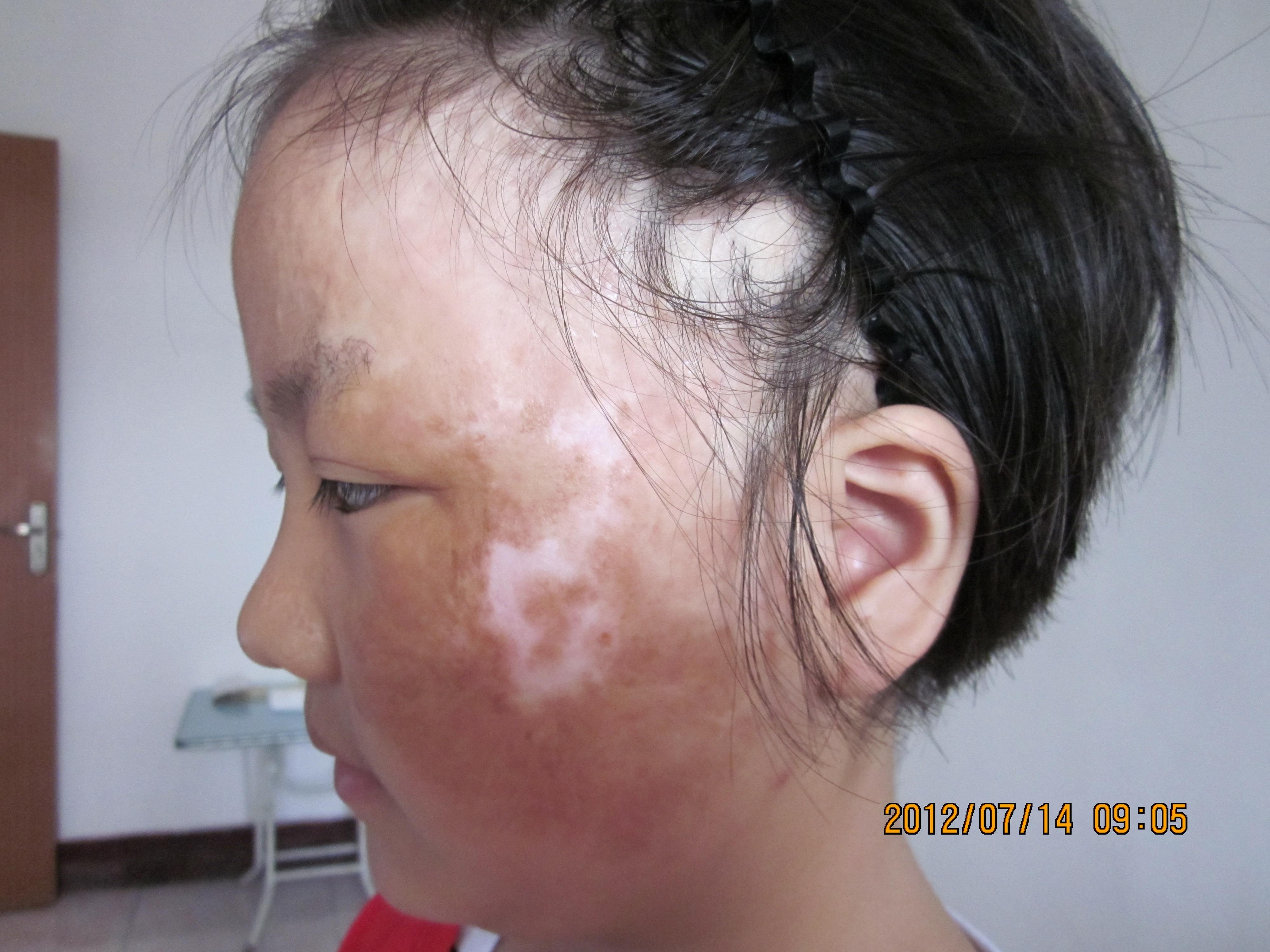 面部烧伤瘢痕求助