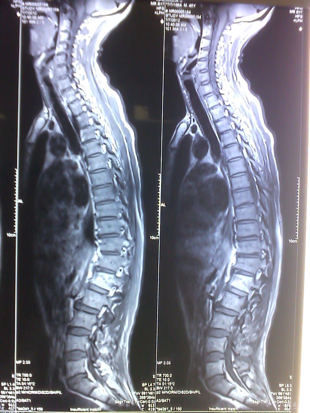 脊椎癌图片