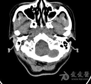 右侧鼻咽侧壁稍增厚颈部淋巴结增大