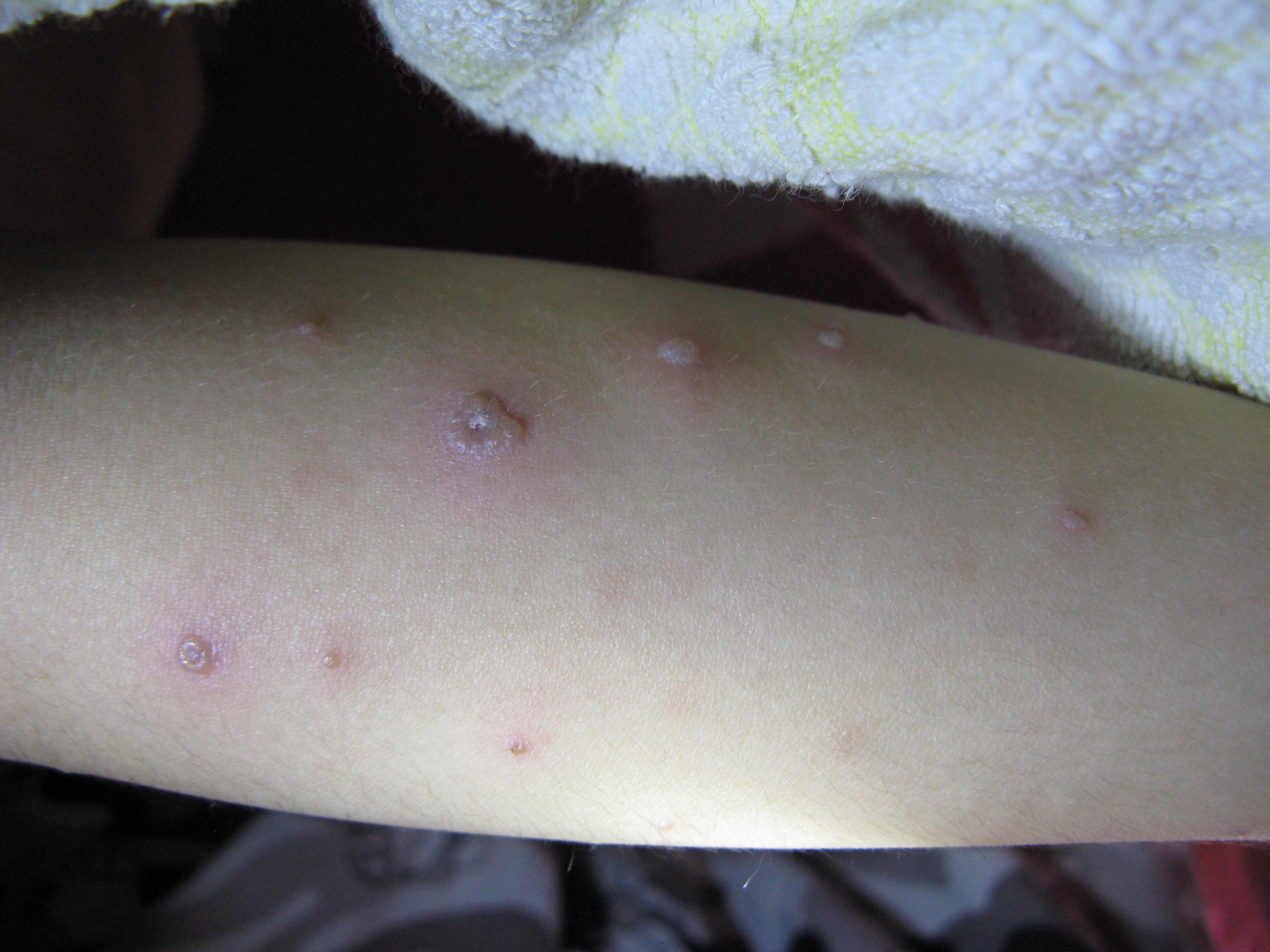 红斑丘疹的症状图片图片