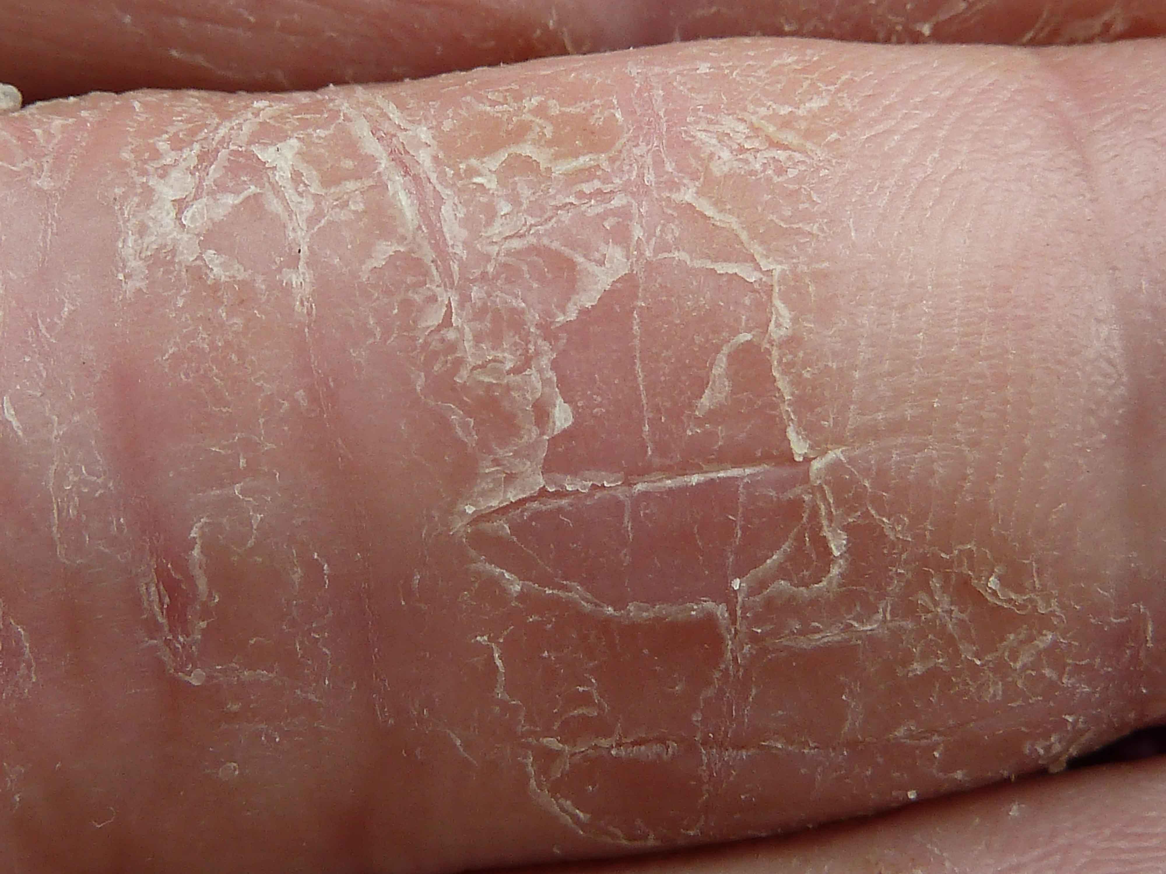 手指角化性湿疹图片