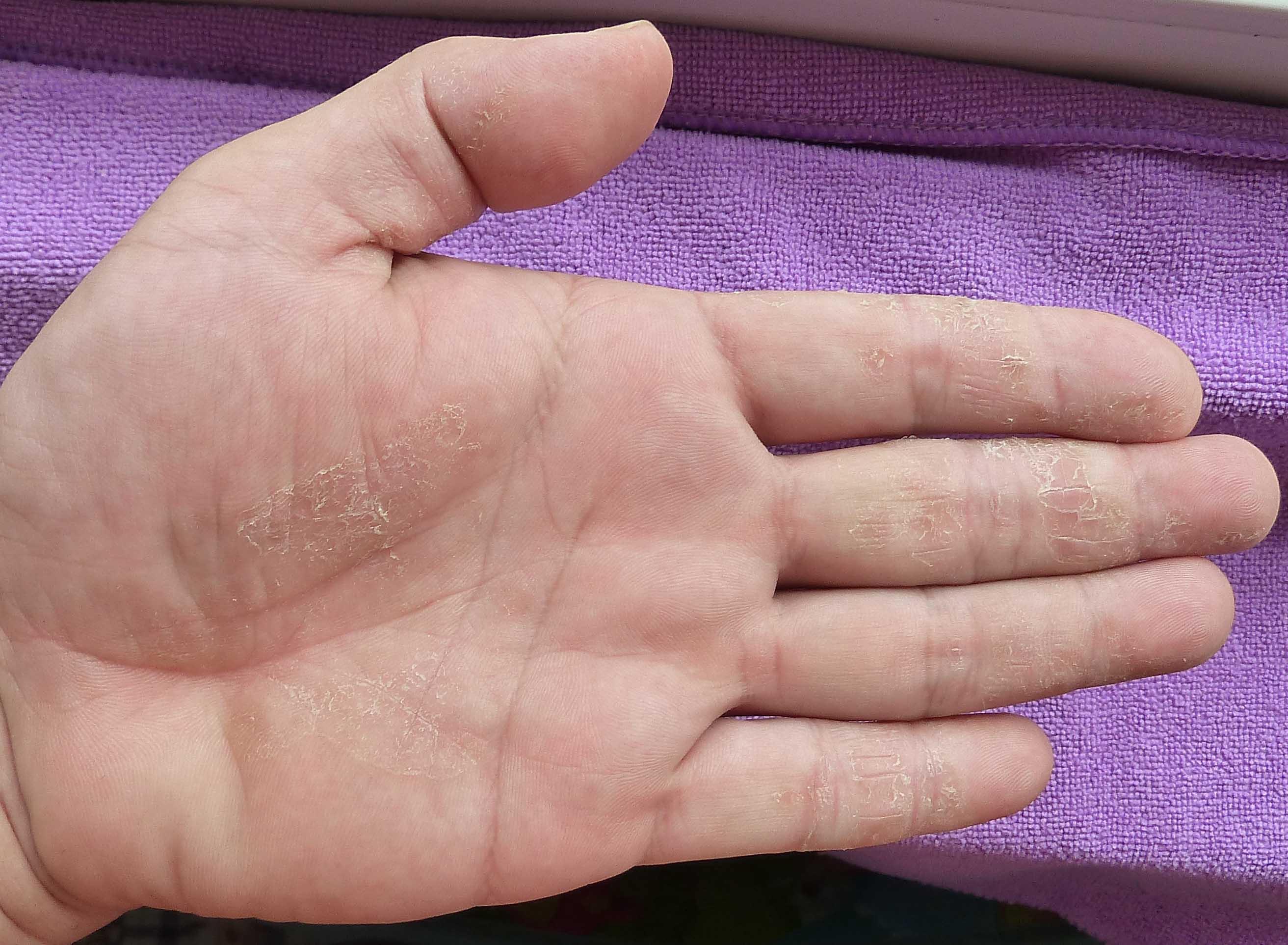 手足皲裂性湿疹图片图片