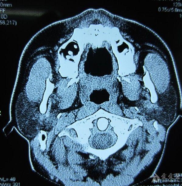 请给位老师帮忙看看需要手术吗?