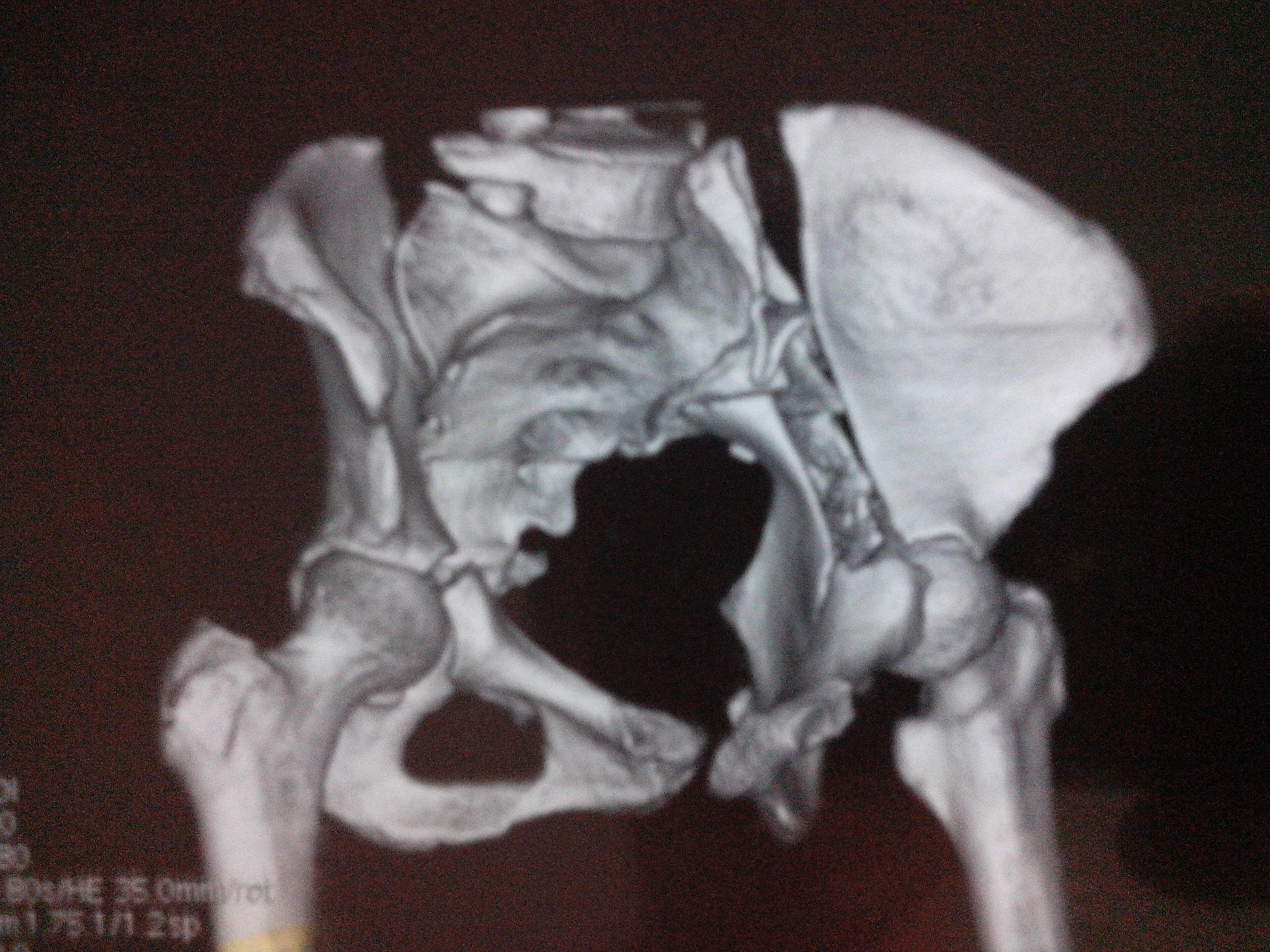看看这个骨盆骨折怎么处理