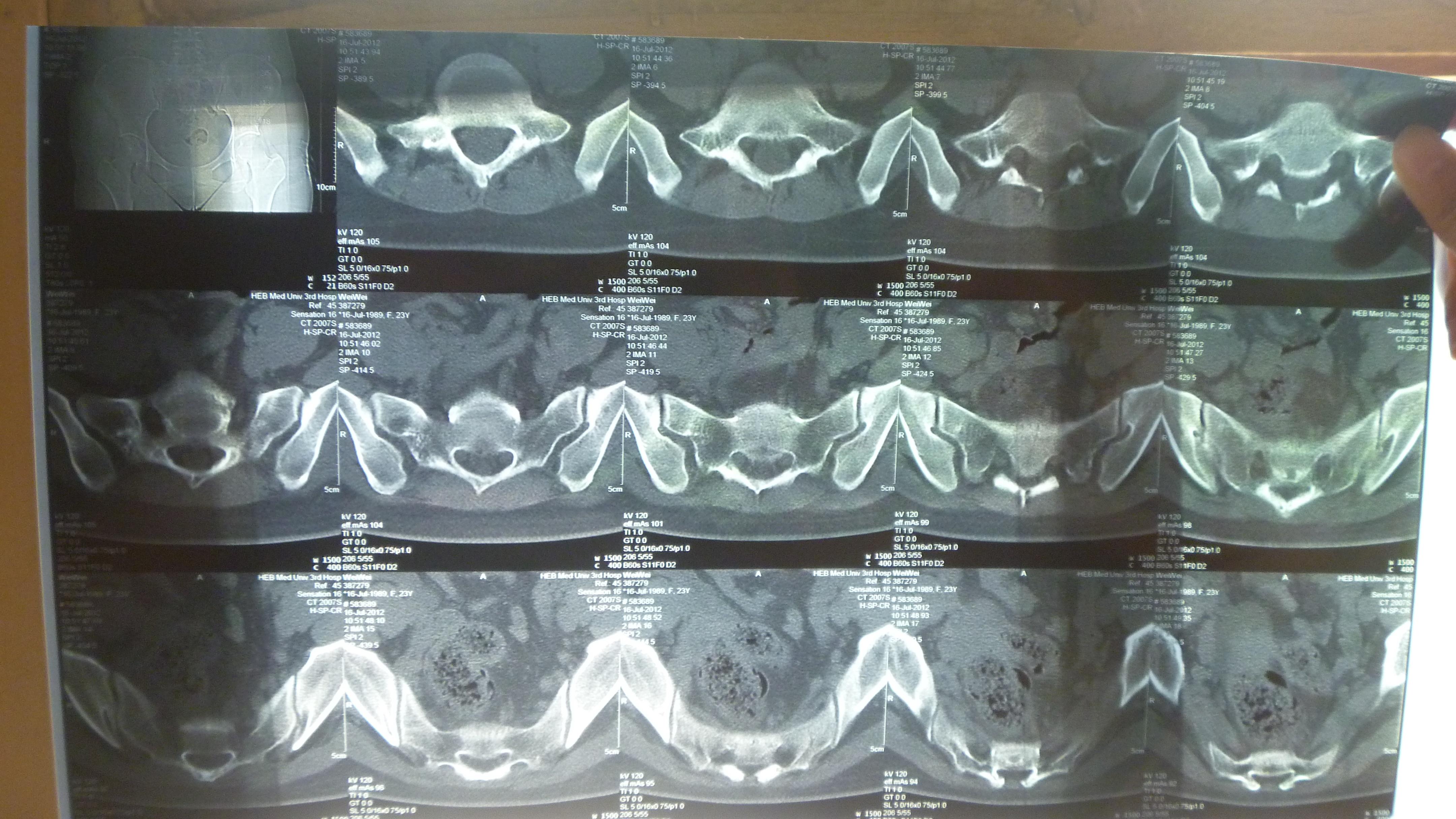 骶髂关节MRI图片