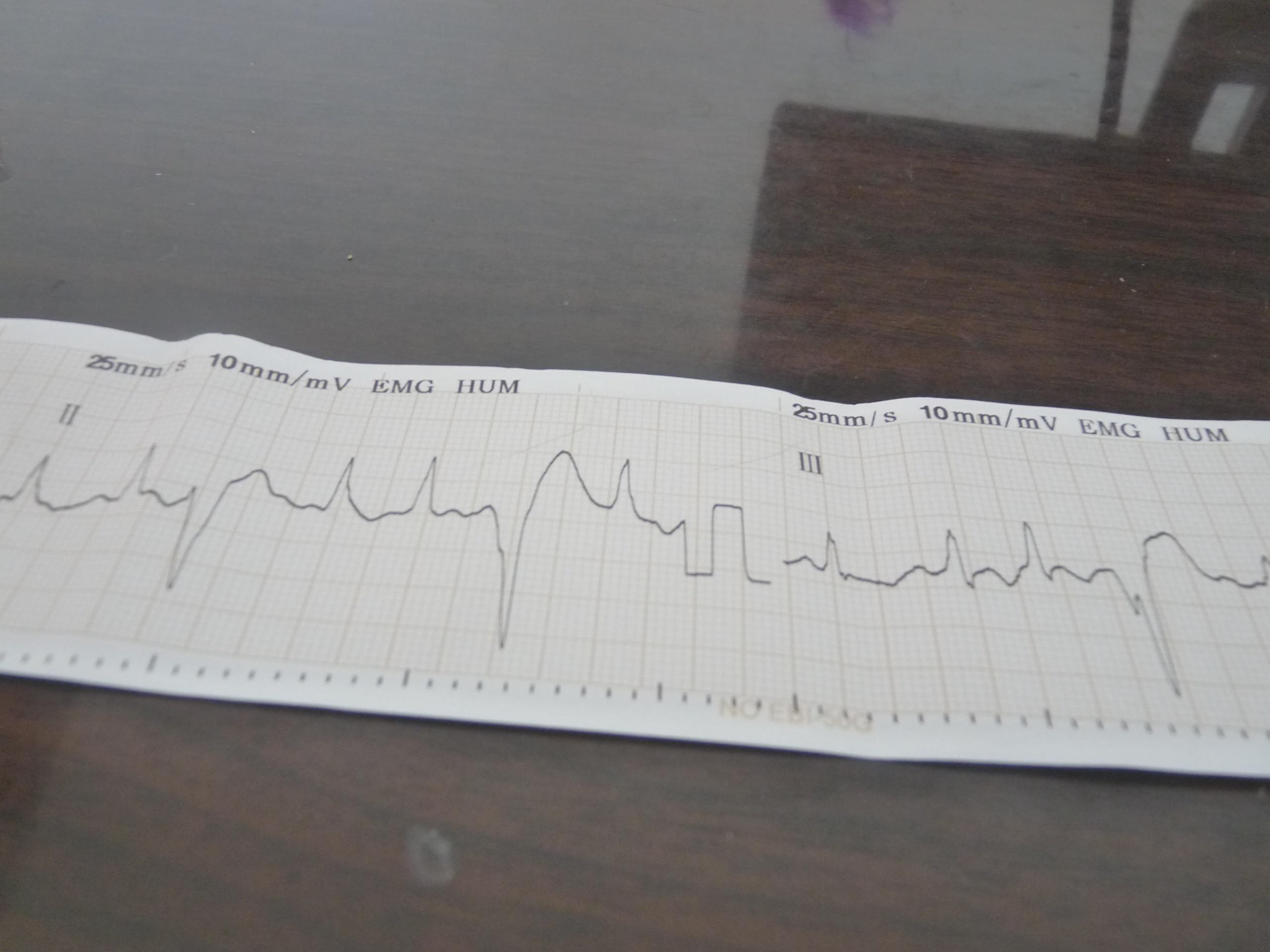 求教心电图,是短阵性室速还是差传