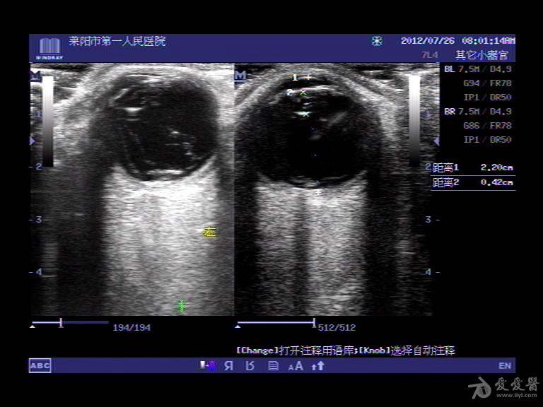 眼部典型病例-----白内障,玻璃体出血 - 超声医学讨论版 - 爱爱医医学