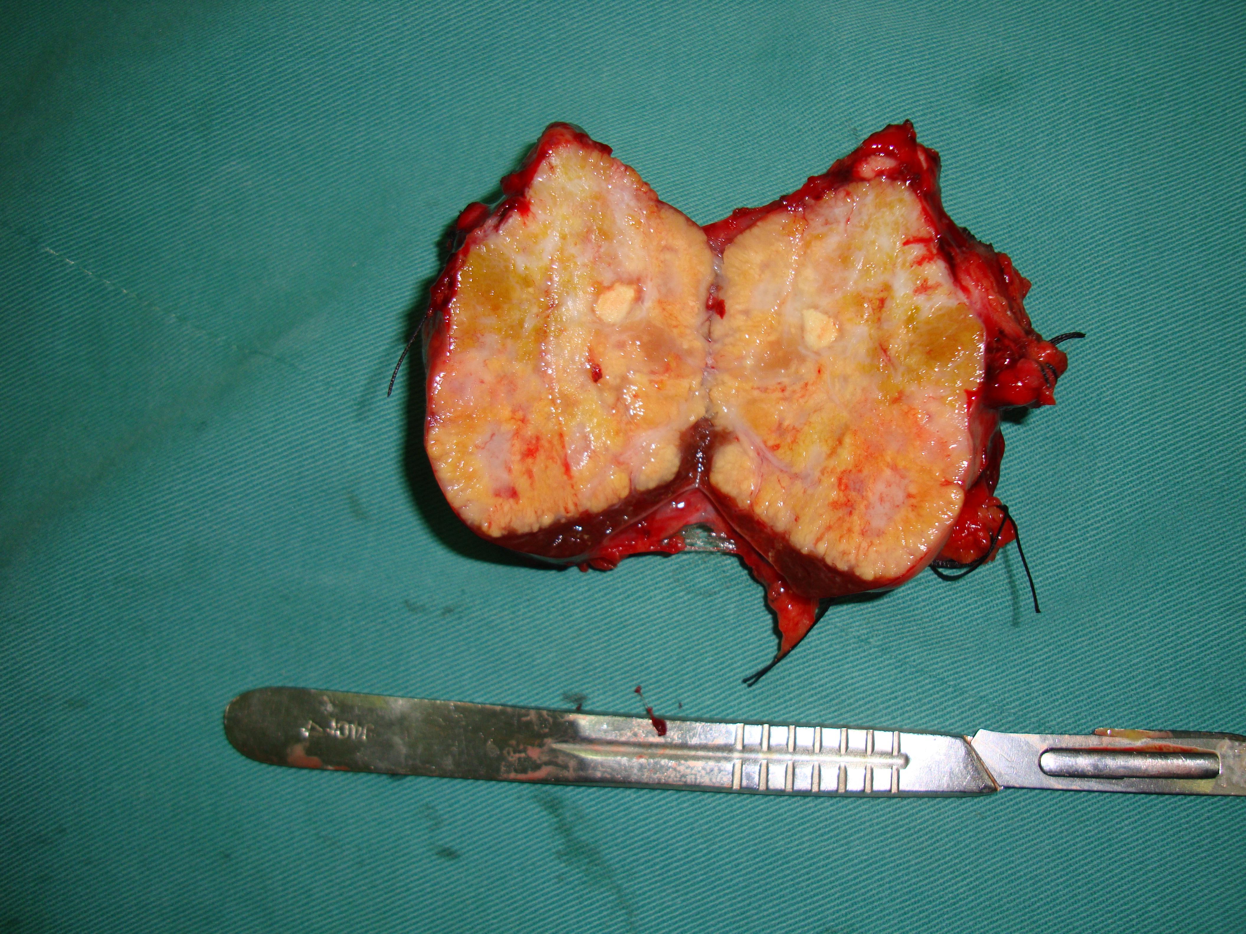 2012-07-24今天做的一台肝尾状叶(癌)切除术