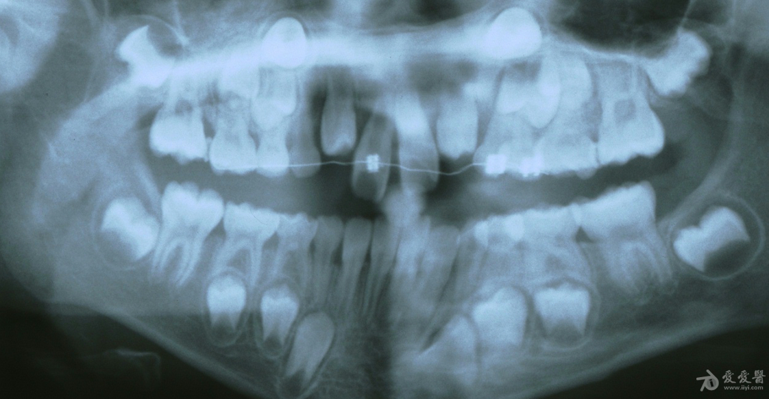 片子显示恒牙胚正在往上顶