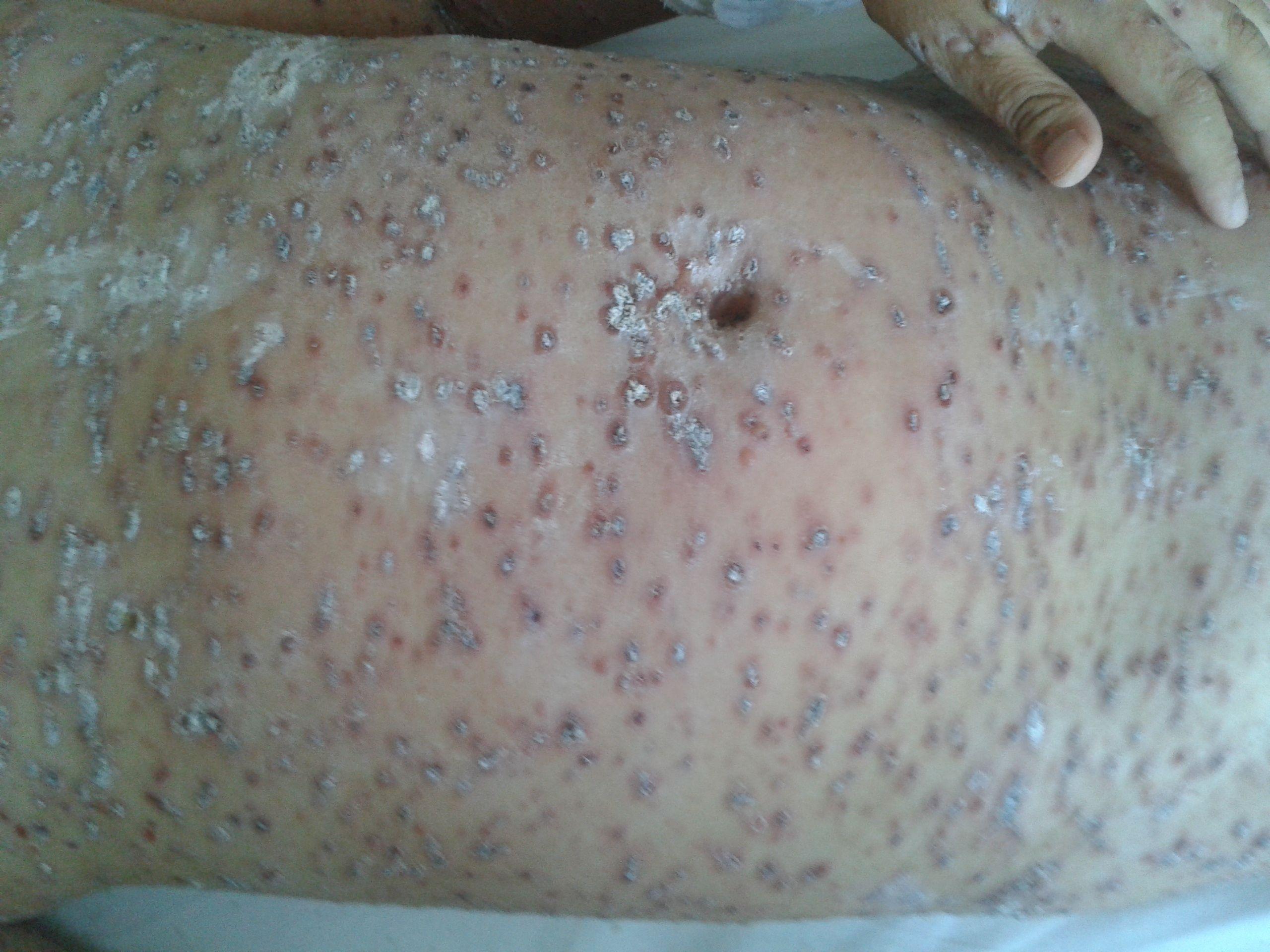 大家帮忙看看这是什么怎么治