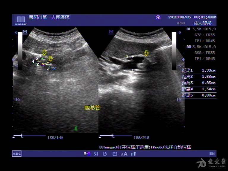 肝内胆管扩张超声图片
