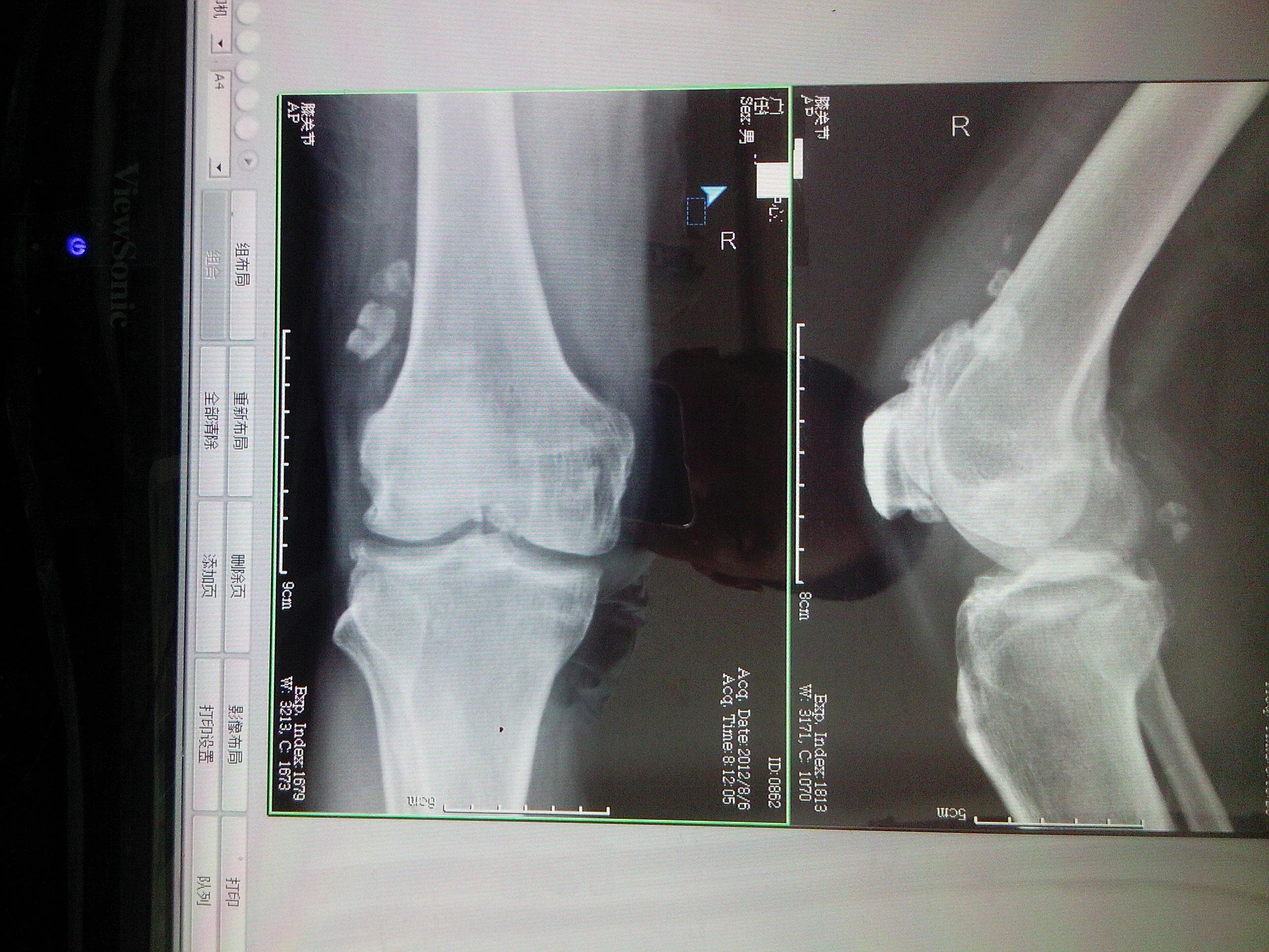 这个膝关节如何诊断