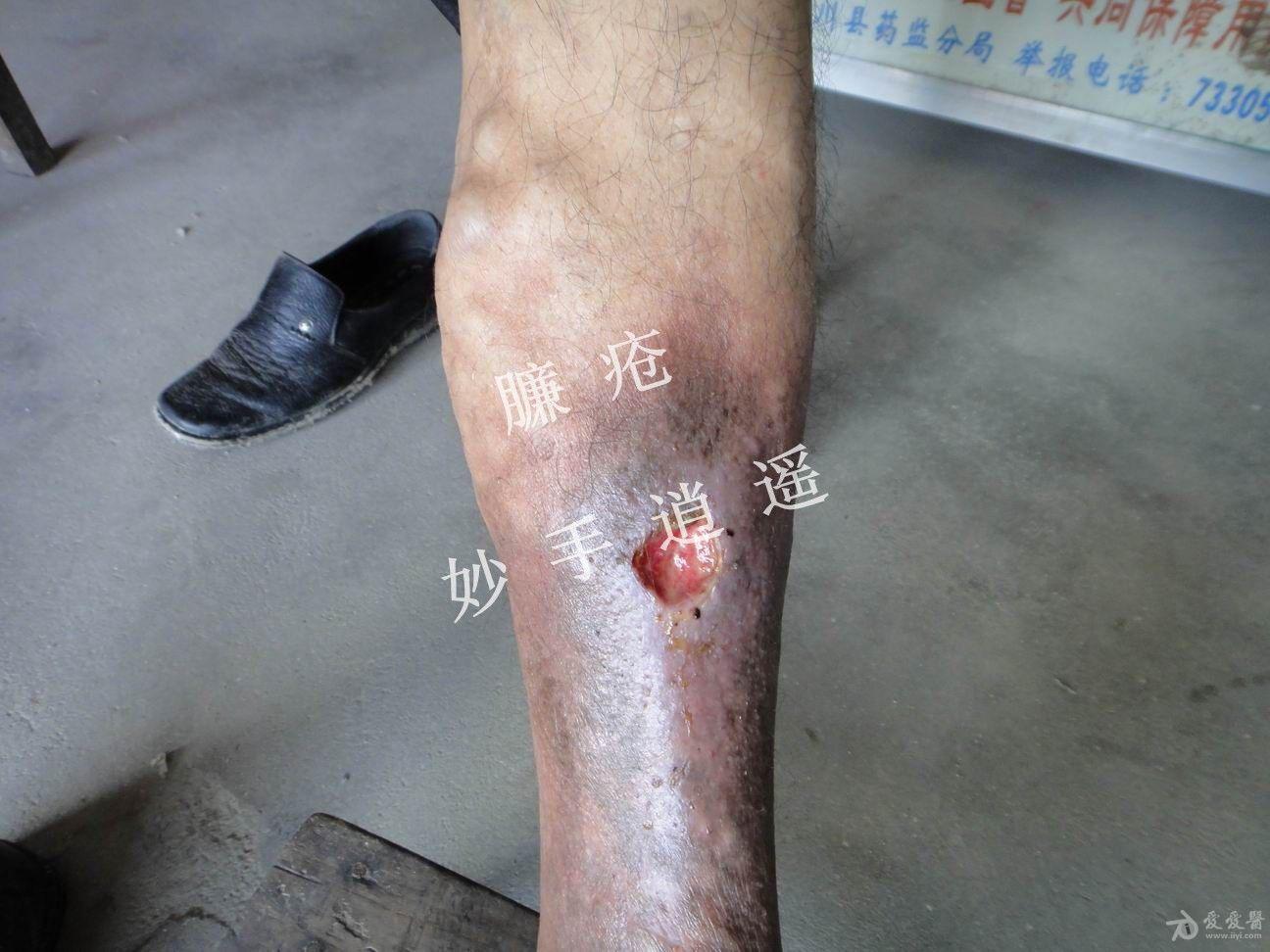 臁疮难道这是传说中的臁疮