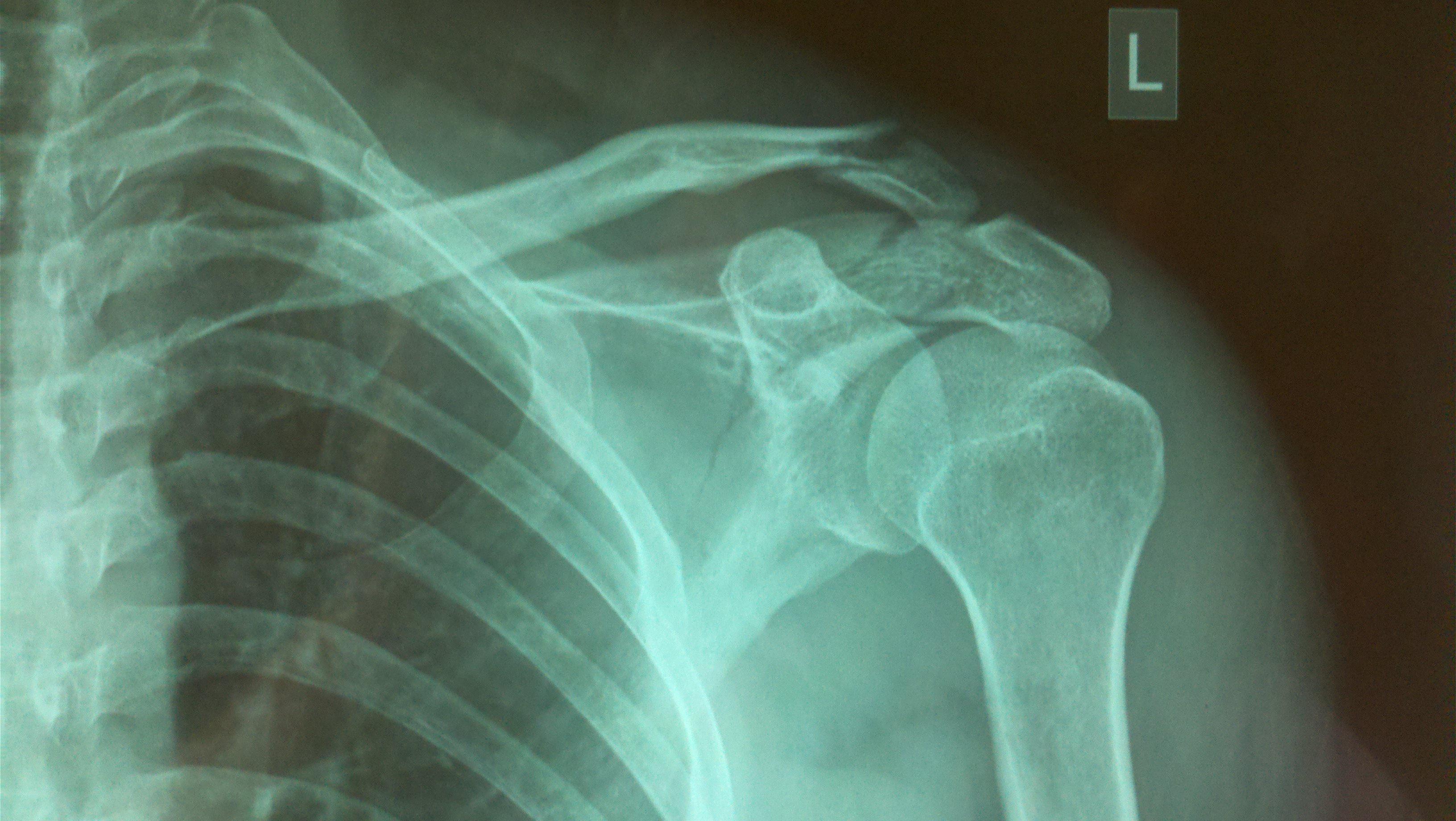 肩胛骨合并锁骨骨折求治疗方案