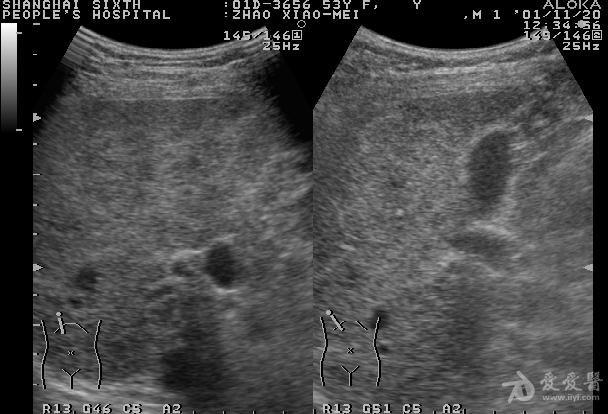 请教肝吸虫声像图表现 