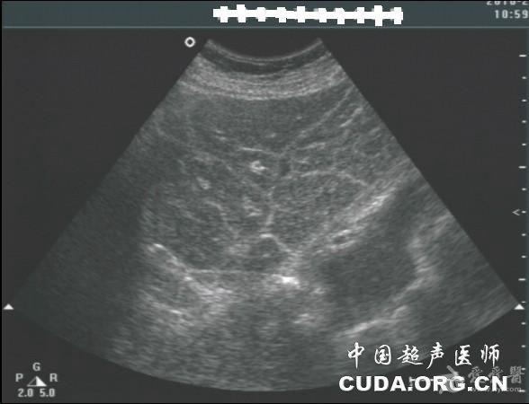 請教肝吸蟲聲像圖表現 - 超聲醫學討論版 - 愛愛醫醫學論壇