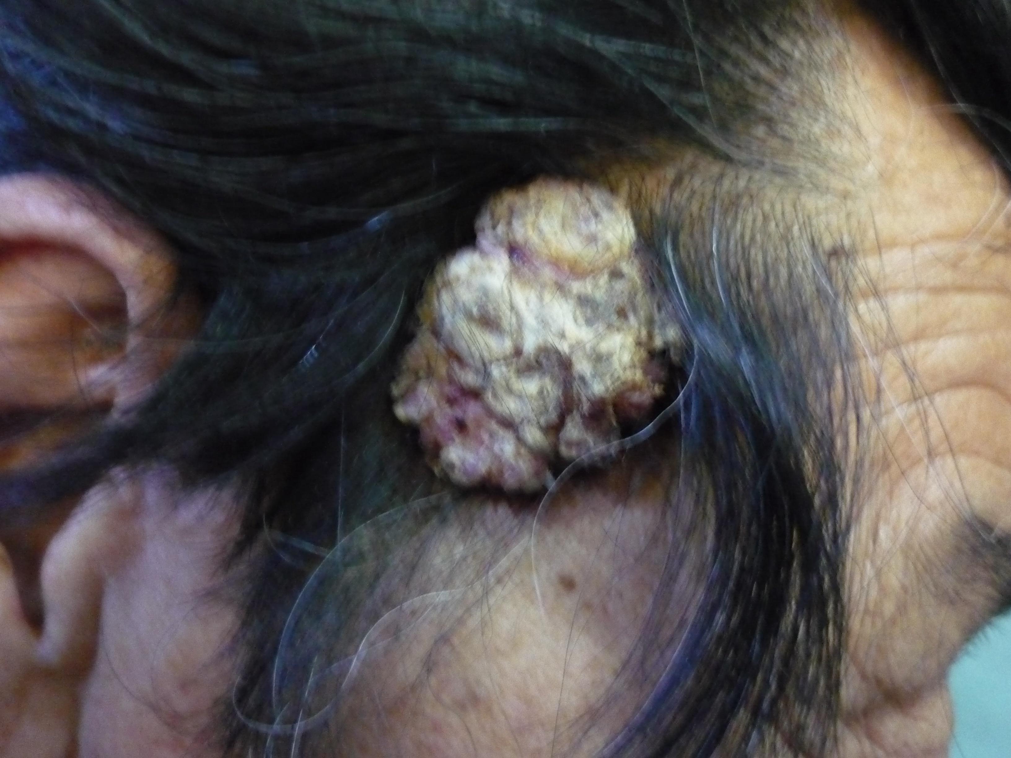 角化棘皮瘤图片癌症图片