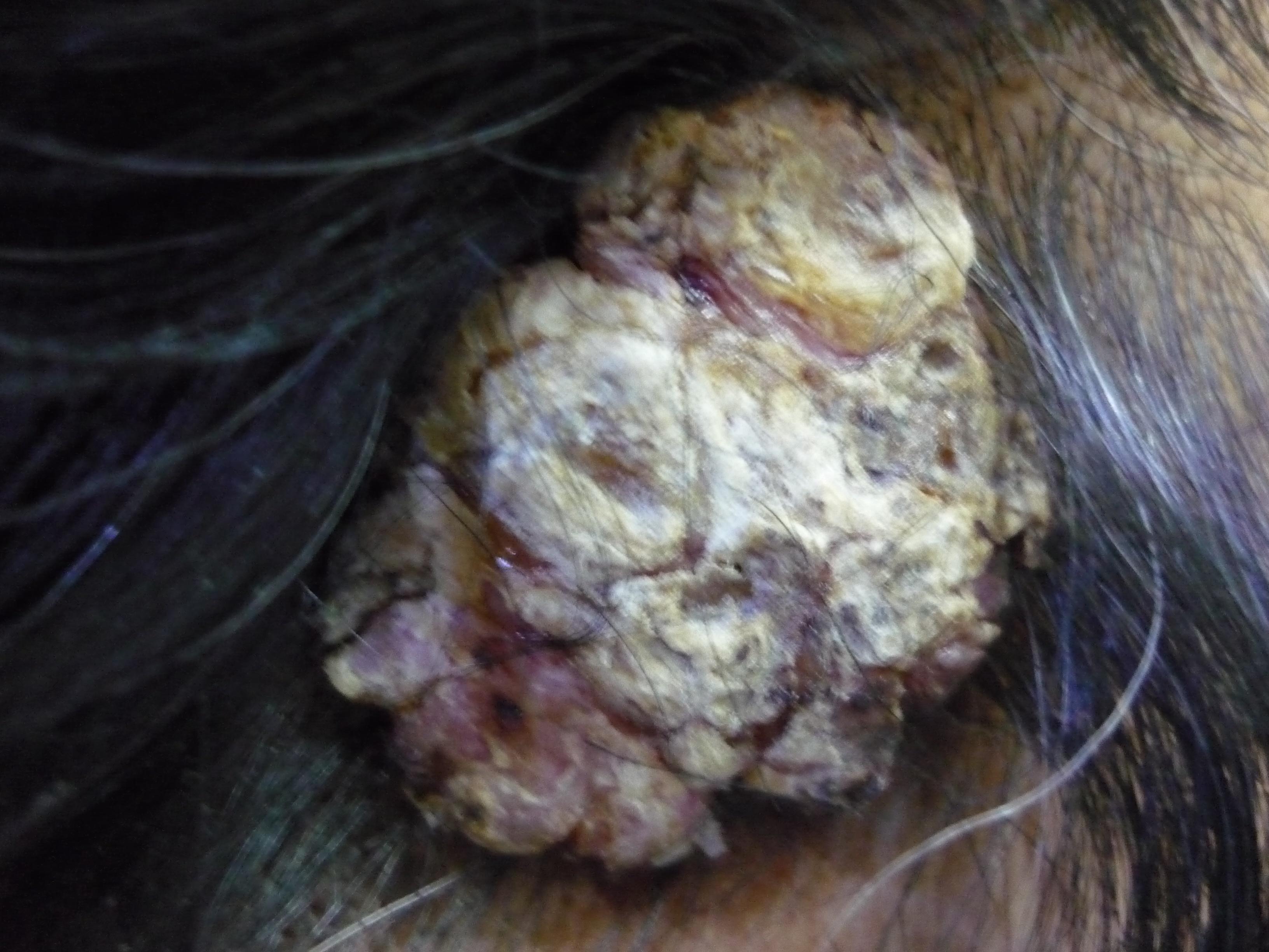 典型病例颞部角化棘皮瘤