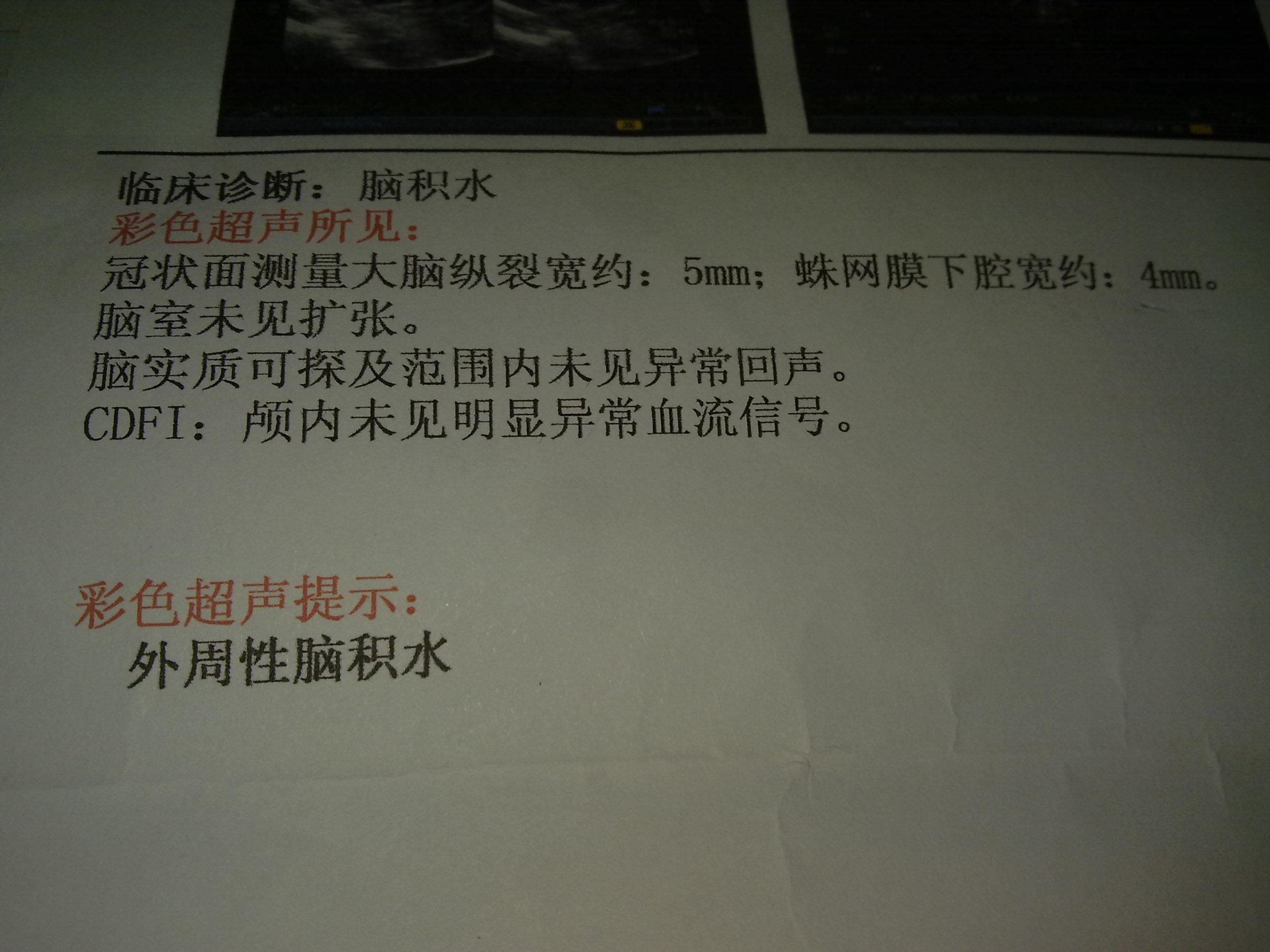 请帮忙看看脑积水严重吗