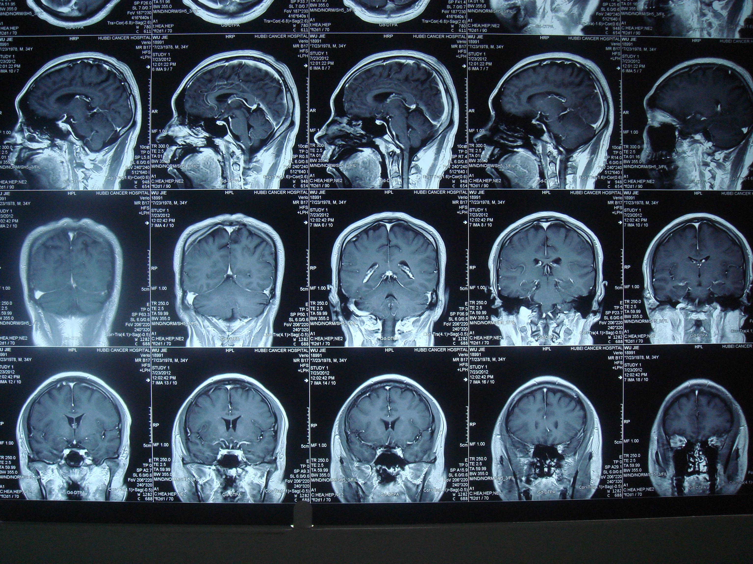 正常脑磁共振图片