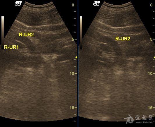 右腎重複腎,輸尿管畸形 - 超聲醫學討論版 - 愛愛醫醫學論壇