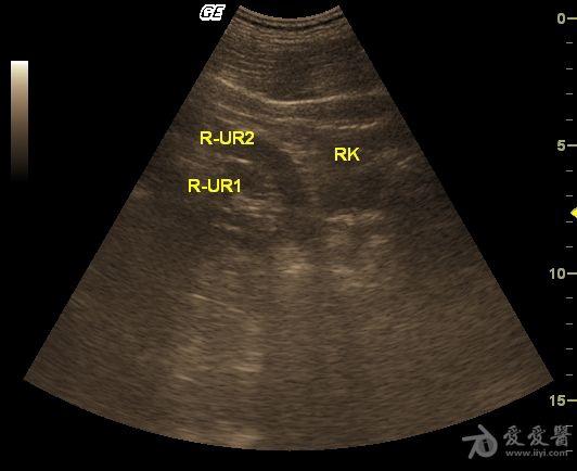 右腎重複腎,輸尿管畸形 - 超聲醫學討論版 - 愛愛醫醫學論壇