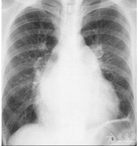 肺淤血ct表现图片图片