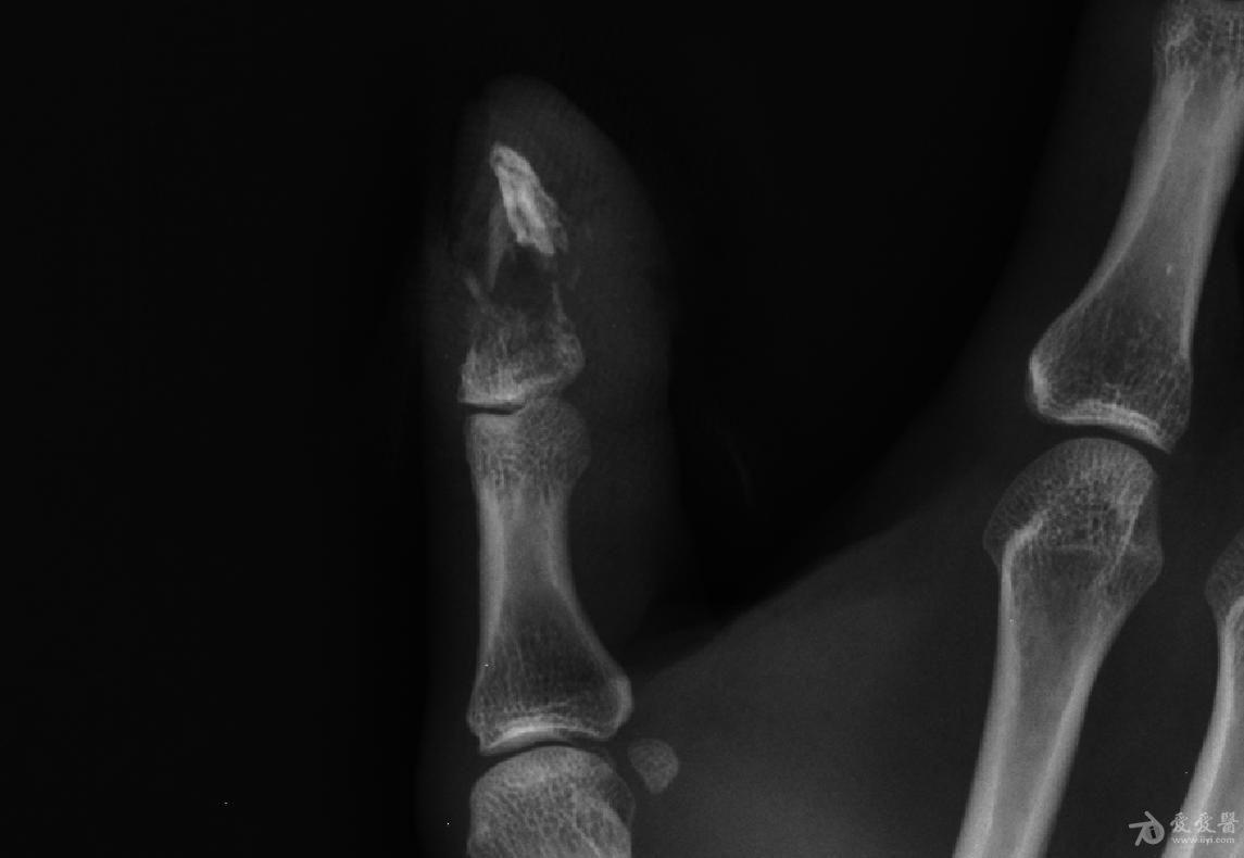 拇指末节骨折手术 搜狗图片搜索