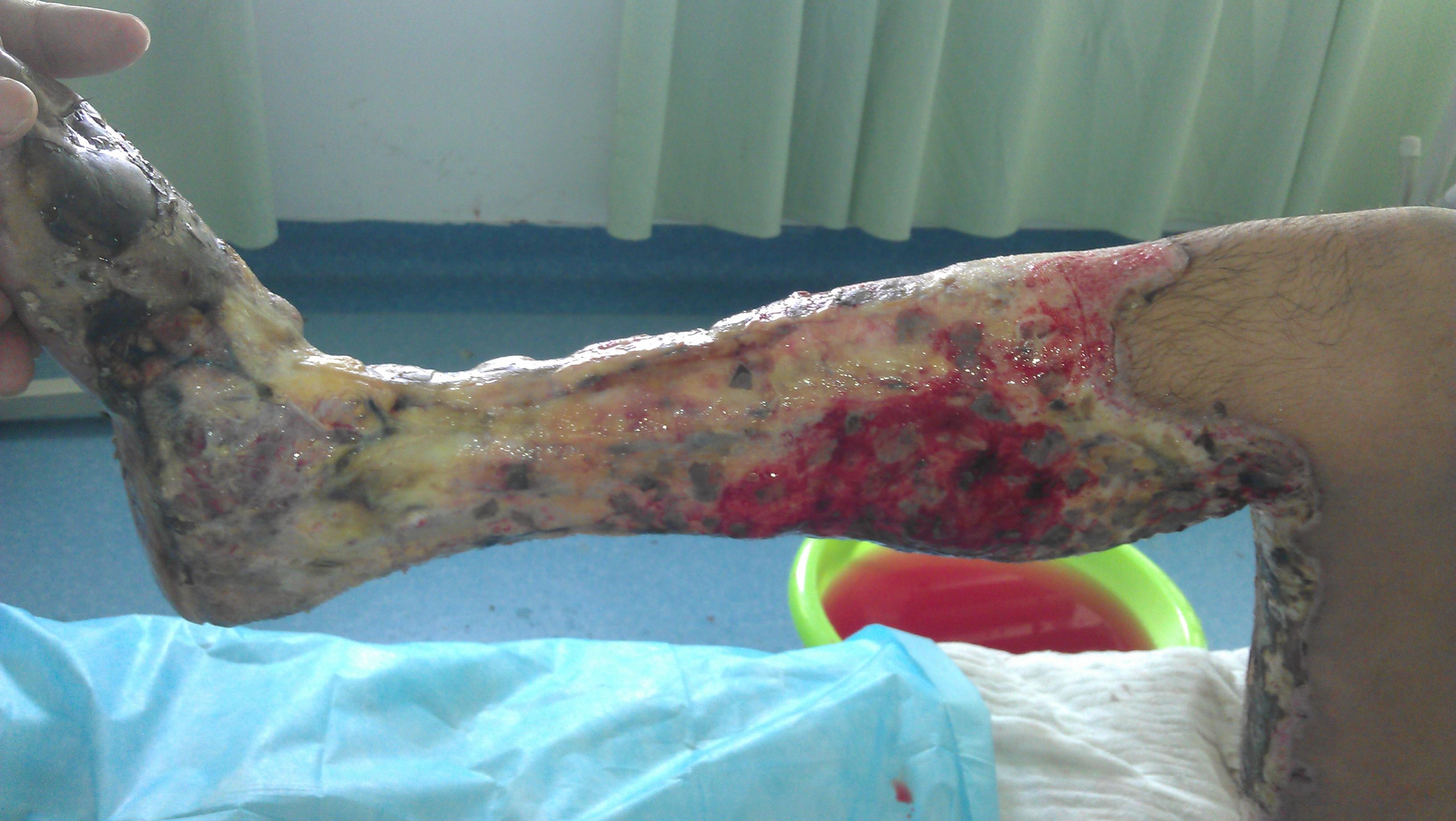 求双下肢大面积34度烧伤后续治疗方案