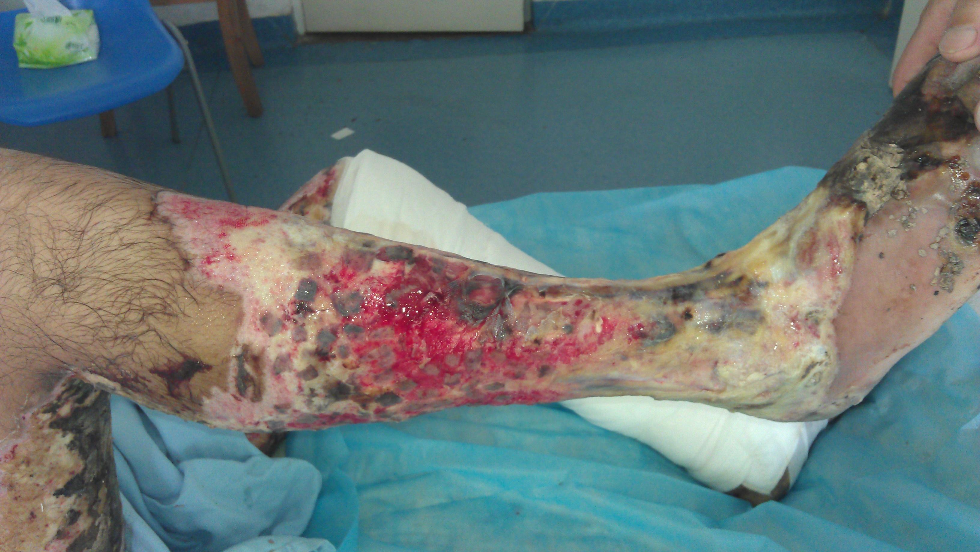 求双下肢大面积34度烧伤后续治疗方案