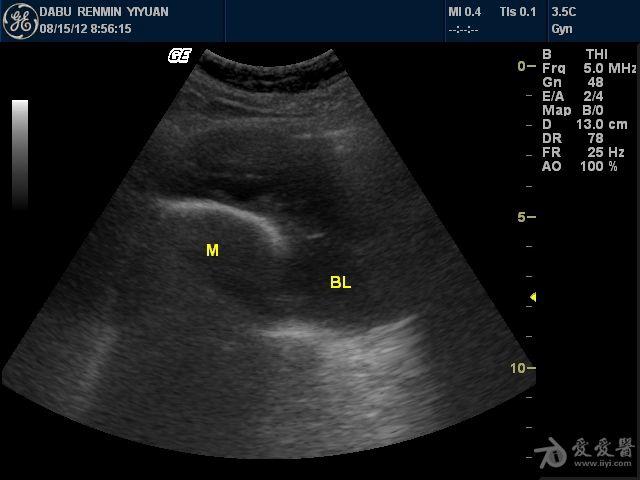 膀胱癌超声图片