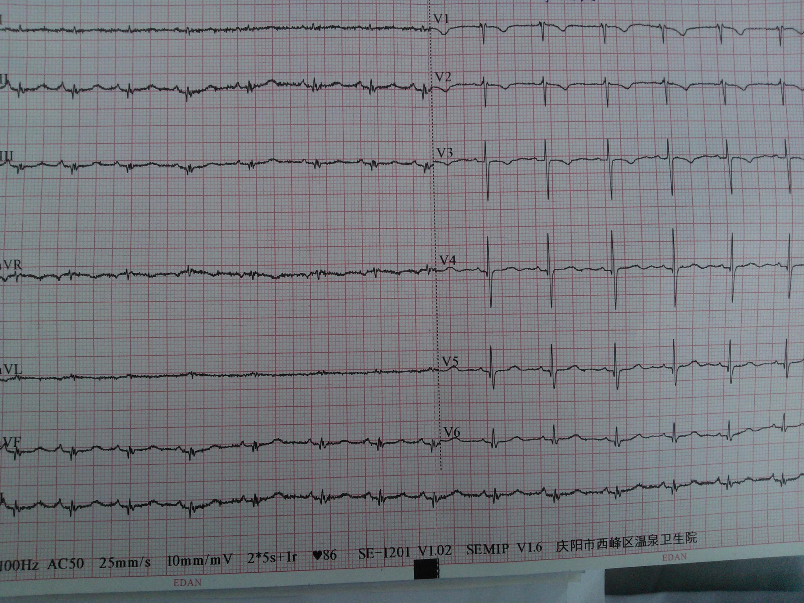 请前辈帮我看看这份心电图