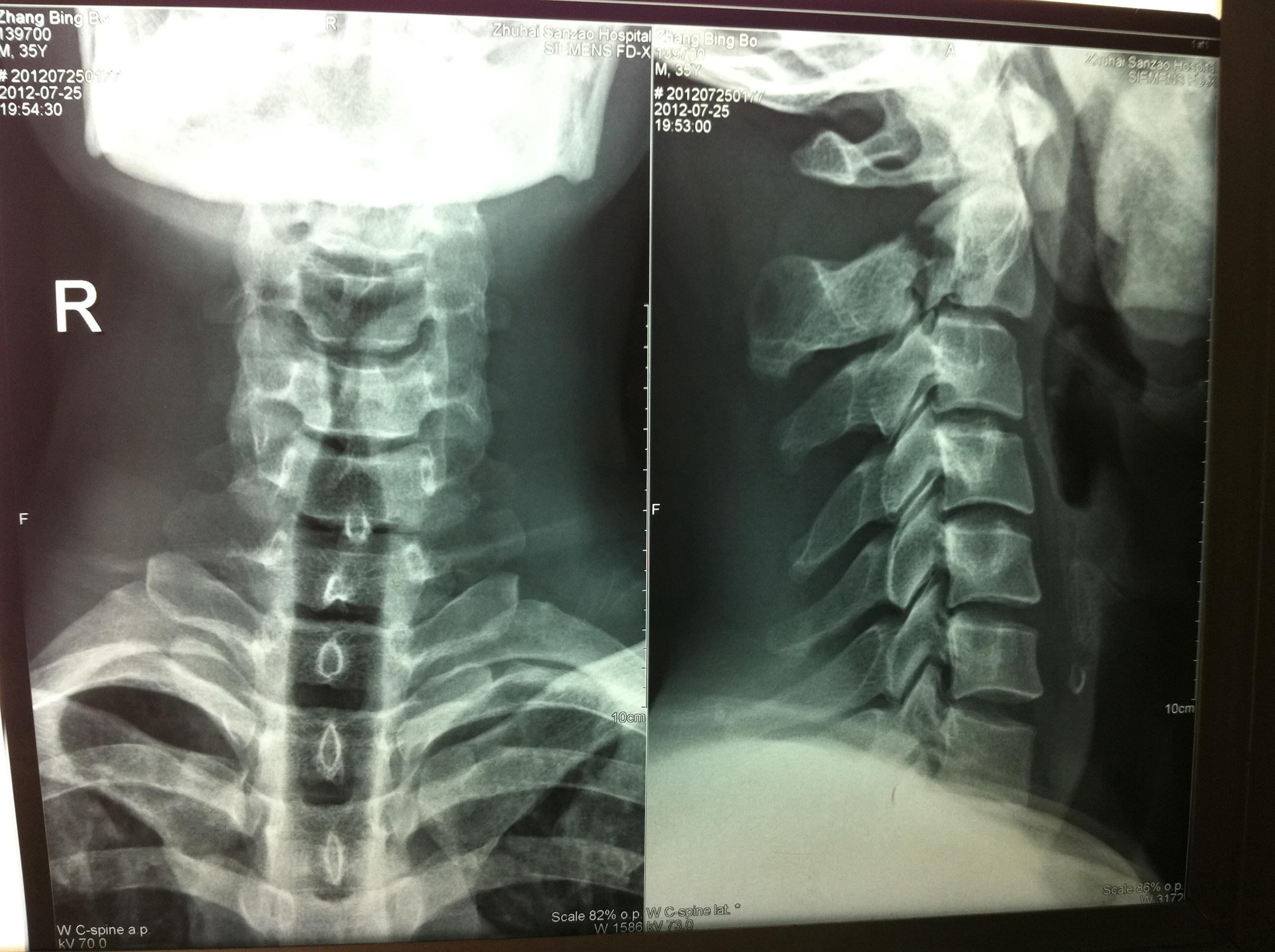 枢椎椎弓骨折讨论治疗