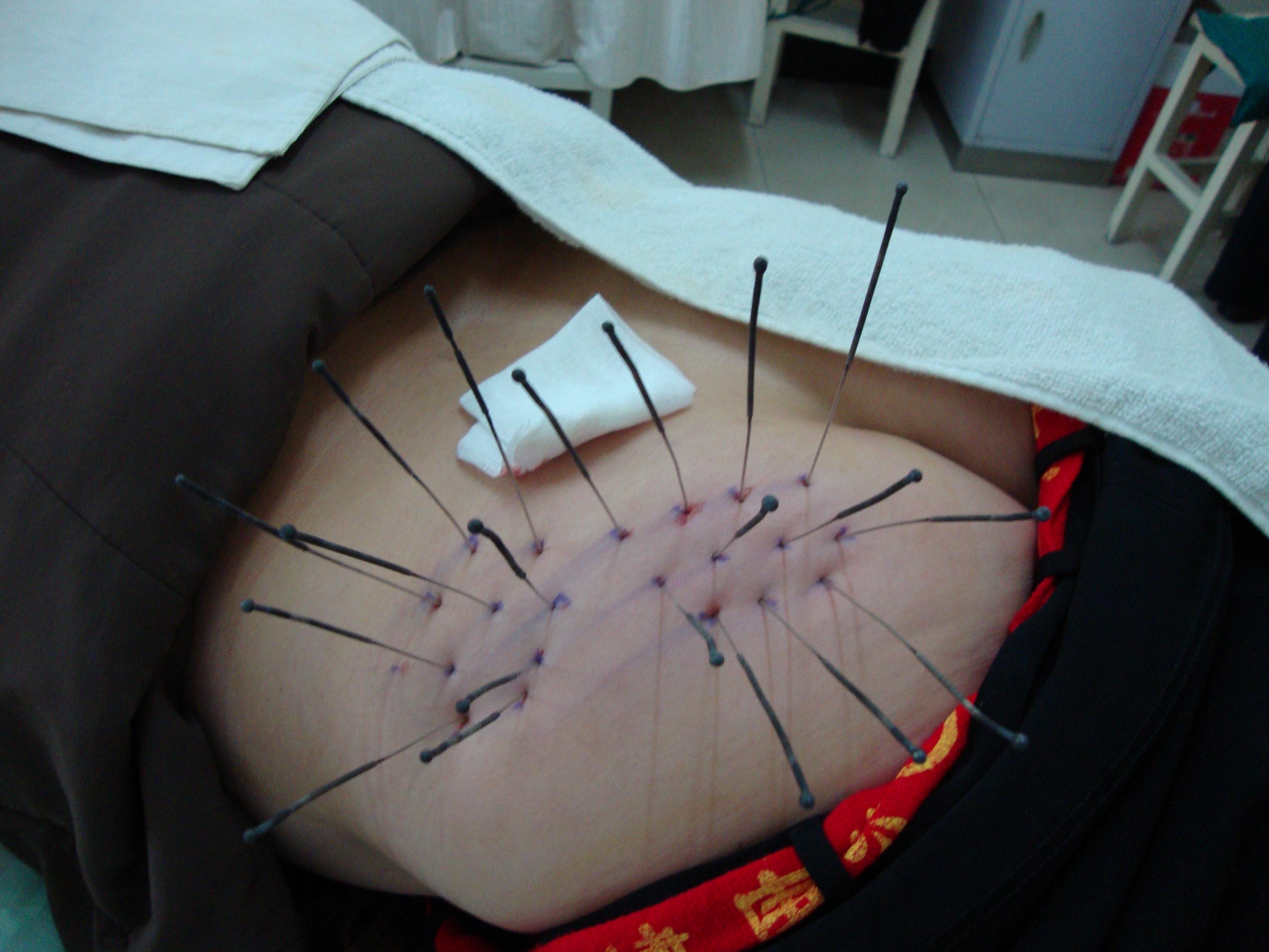 银质针臀部密集疗法图片