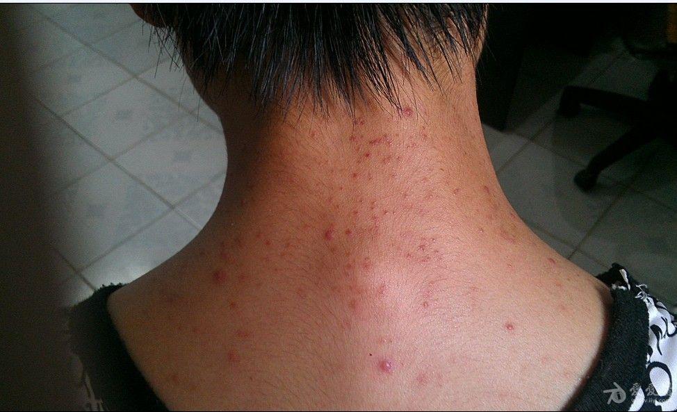 大家看看湿疹日光性皮炎马拉色毛囊炎