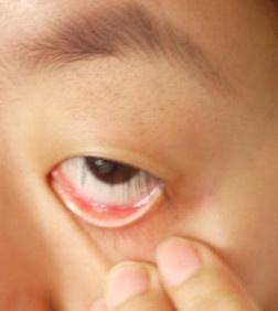 求助结膜炎持续半个多月未见好转