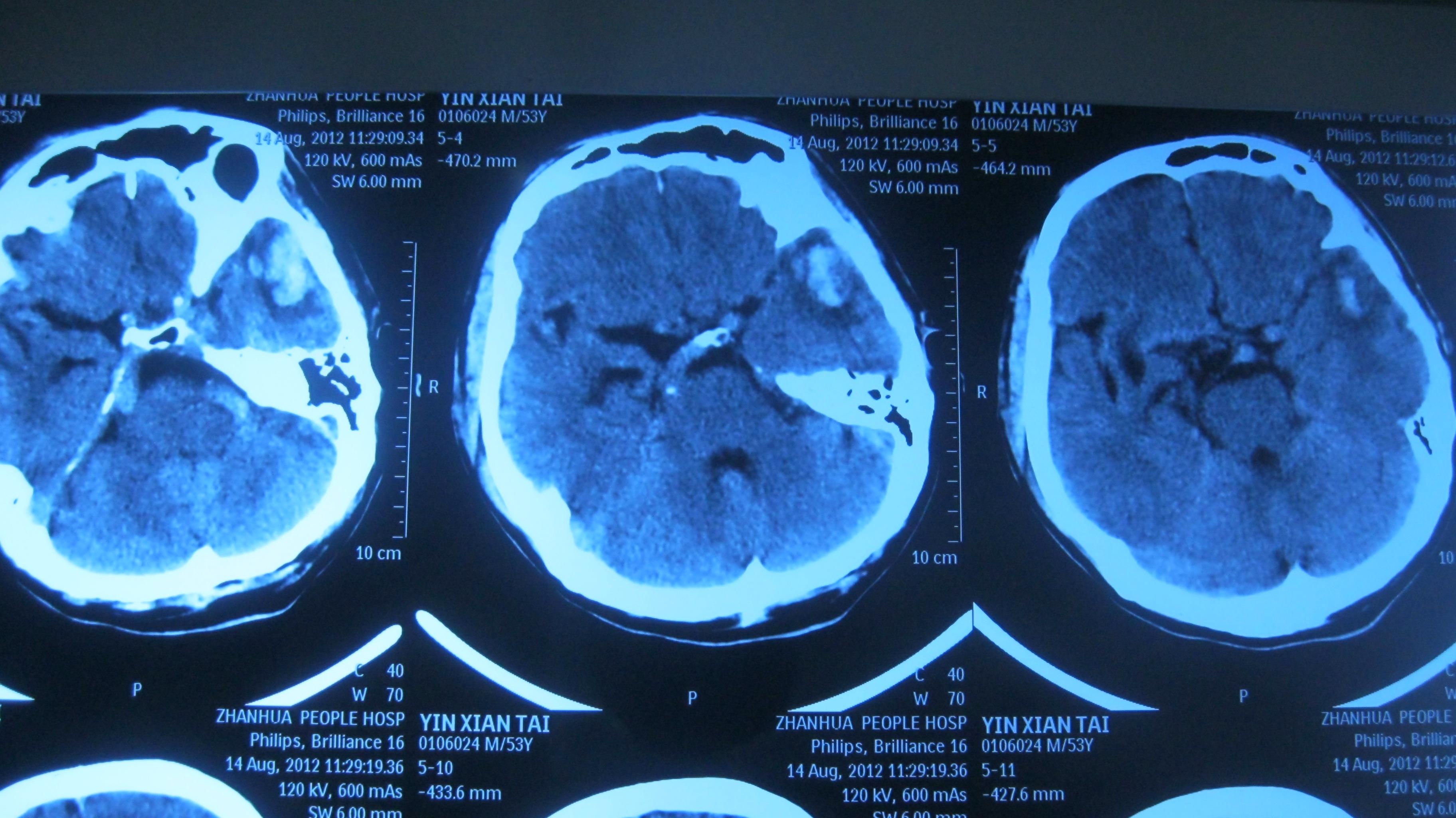 外伤后脑挫伤发现基底节区占位大家看看啥性质