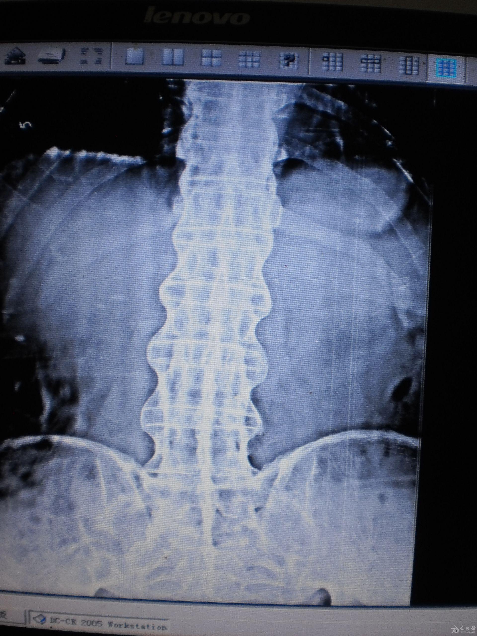强直性脊柱炎 ct图片