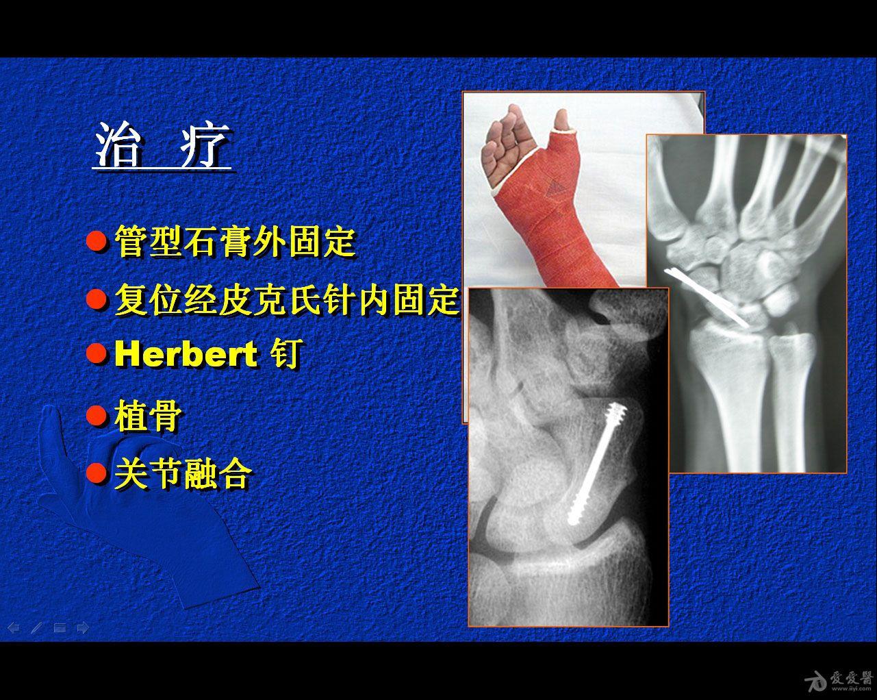 闭合复位经皮埋头空心螺钉治疗腕舟骨骨折50期读片会