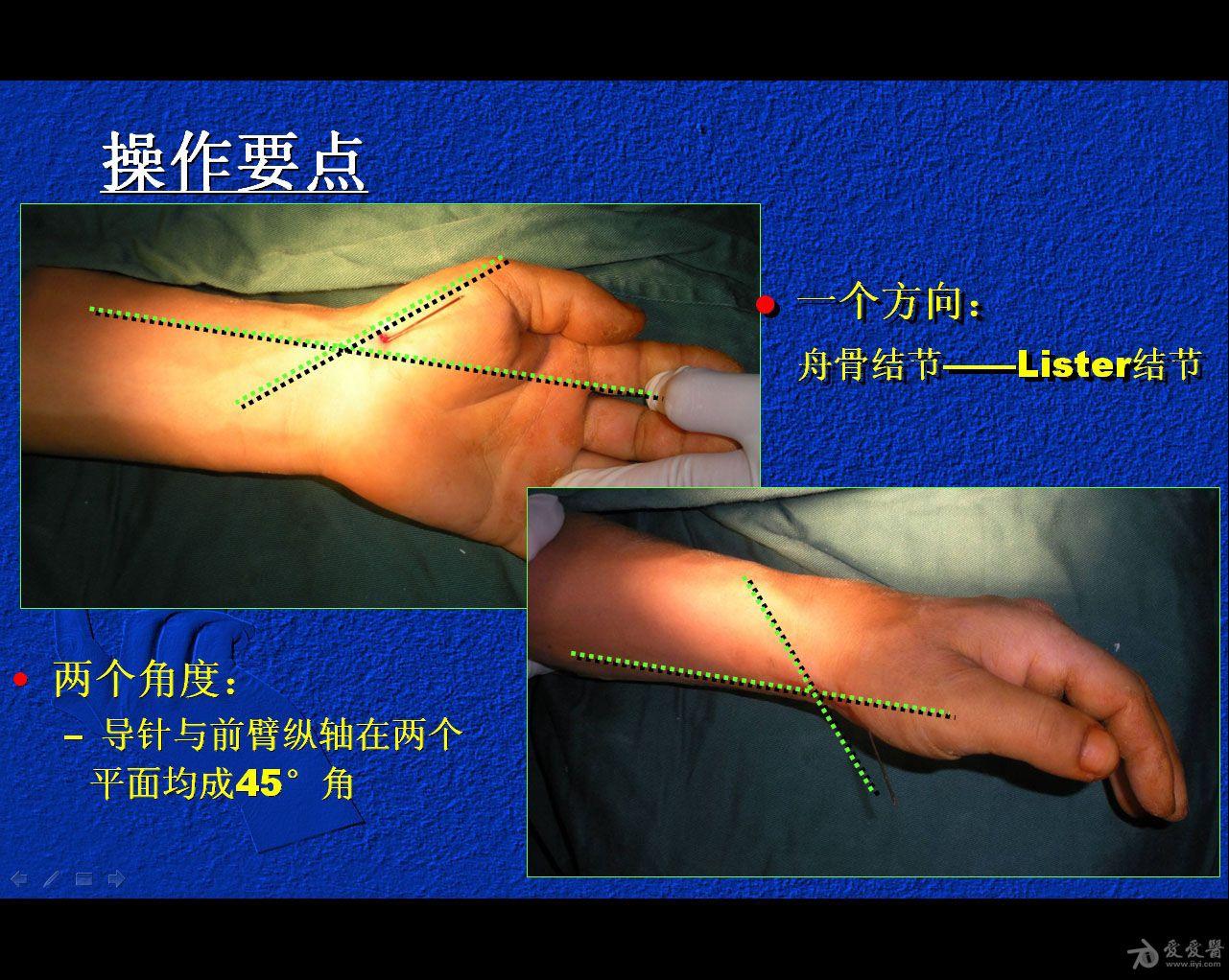 闭合复位经皮埋头空心螺钉治疗腕舟骨骨折50期读片会