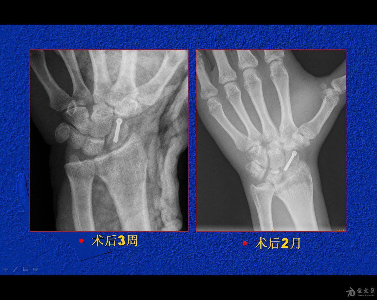 闭合复位经皮埋头空心螺钉治疗腕舟骨骨折50期读片会