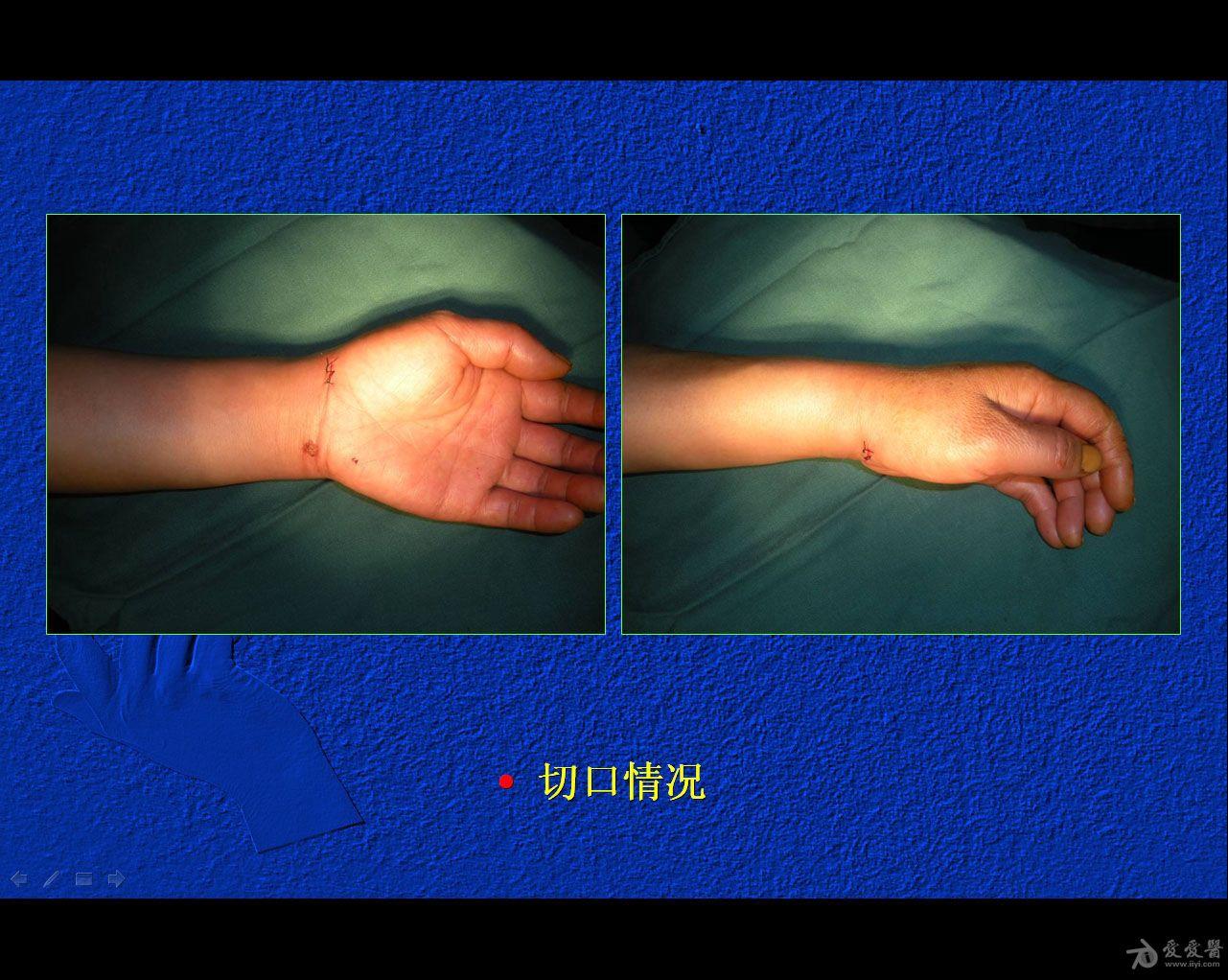 闭合复位经皮埋头空心螺钉治疗腕舟骨骨折50期读片会